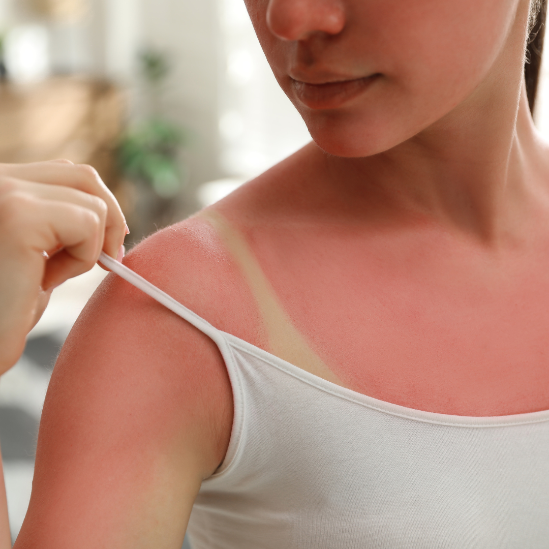 Skin Cancer: Understanding the Individuals Most at Risk