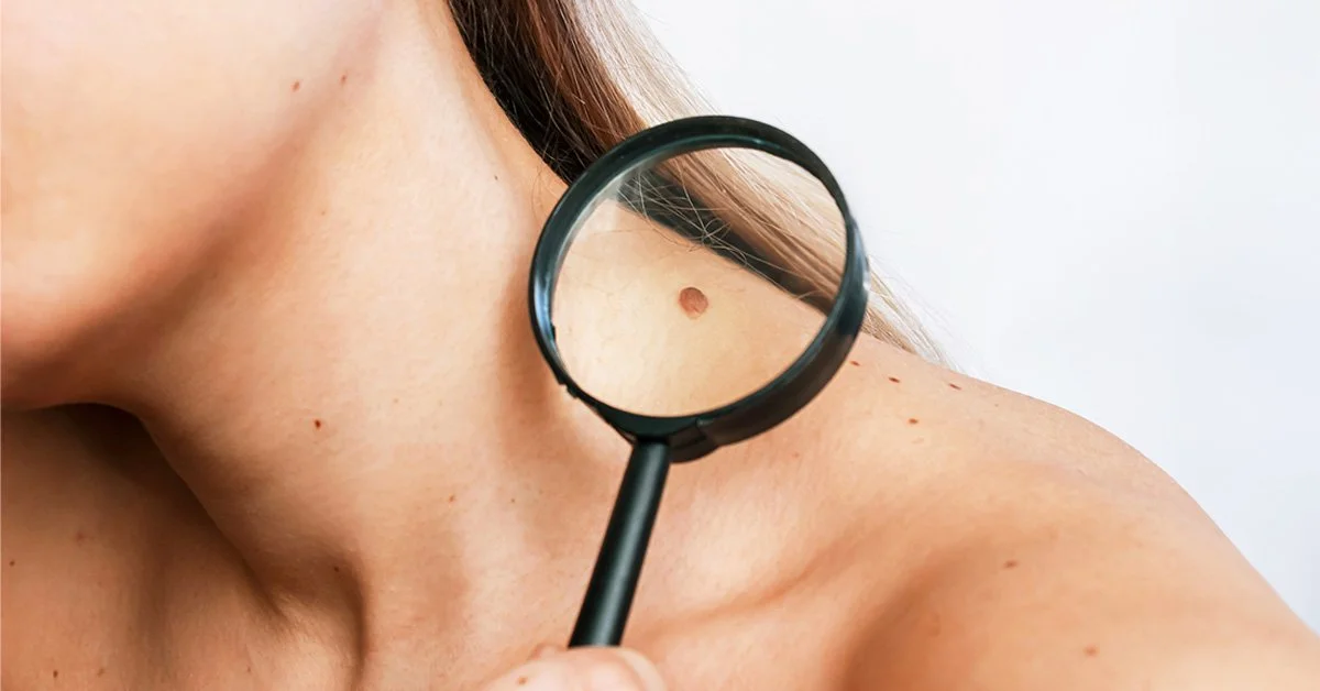 The High Cost of Waiting: Why Ignoring a Suspicious Skin Spot Could Cost You More Than You Think