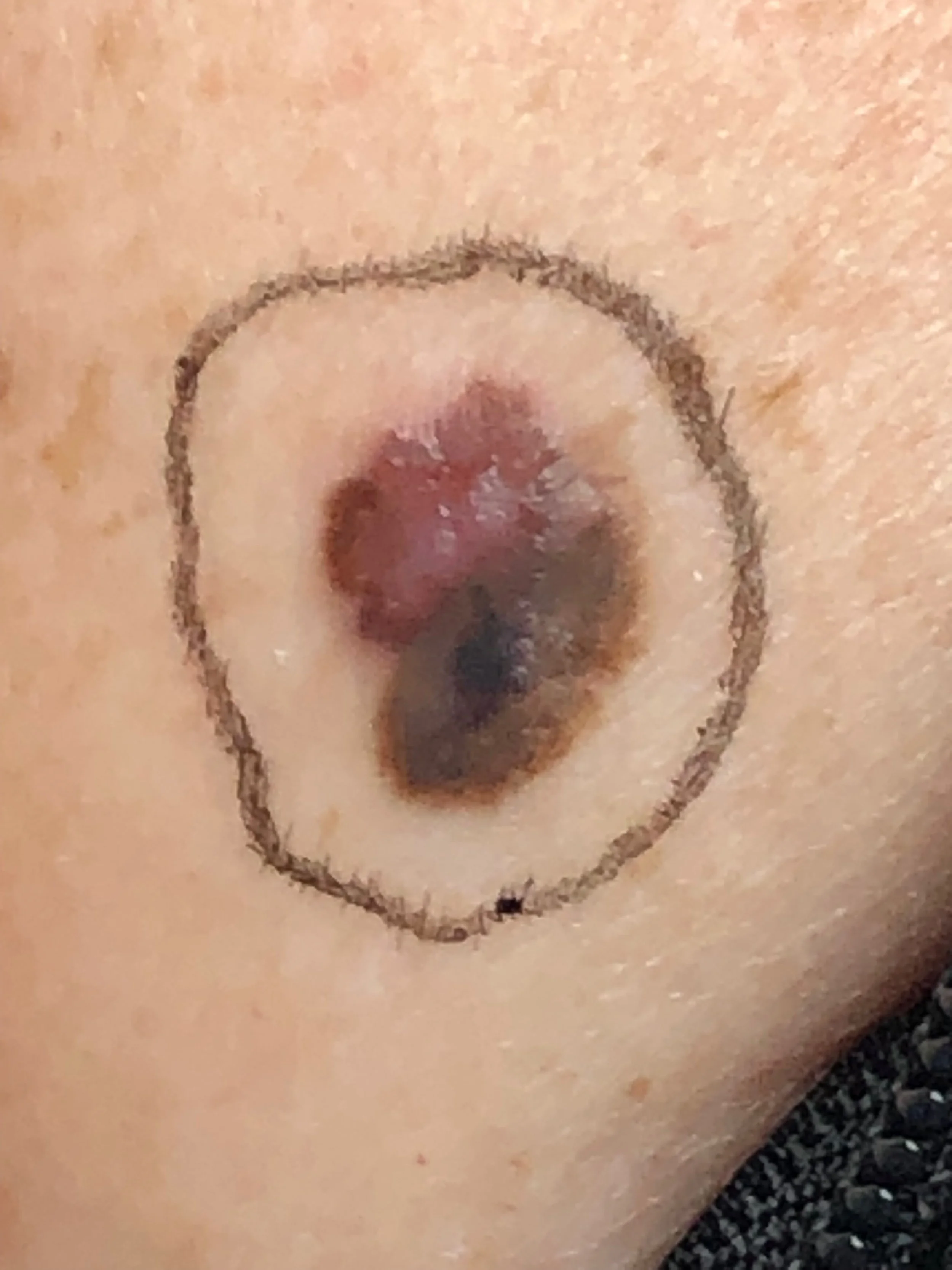 Understanding Melanoma Skin Cancer: Causes, Symptoms, and Prevention