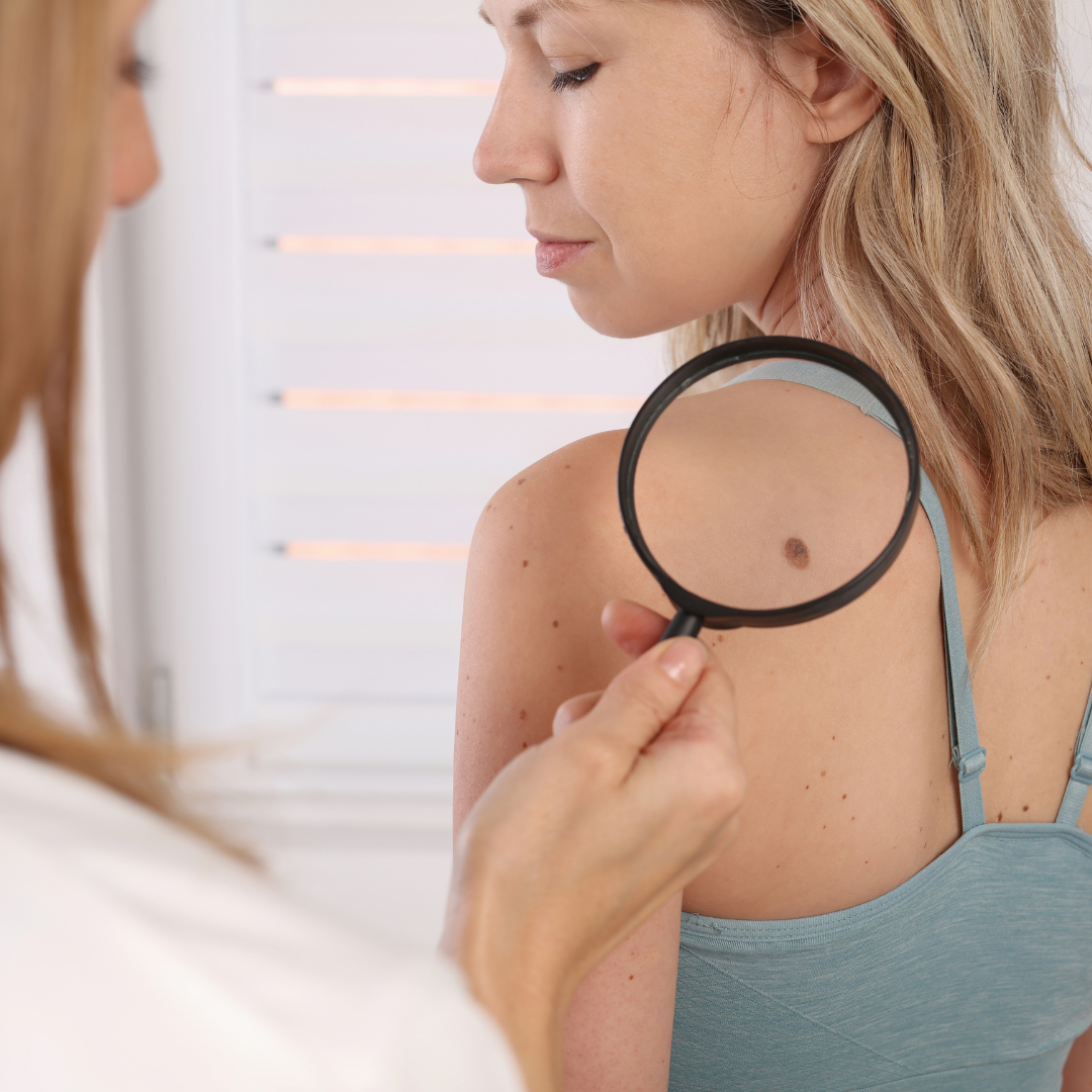 Understanding Moles vs. Skin Cancer: Know the Difference for Better Skin Health