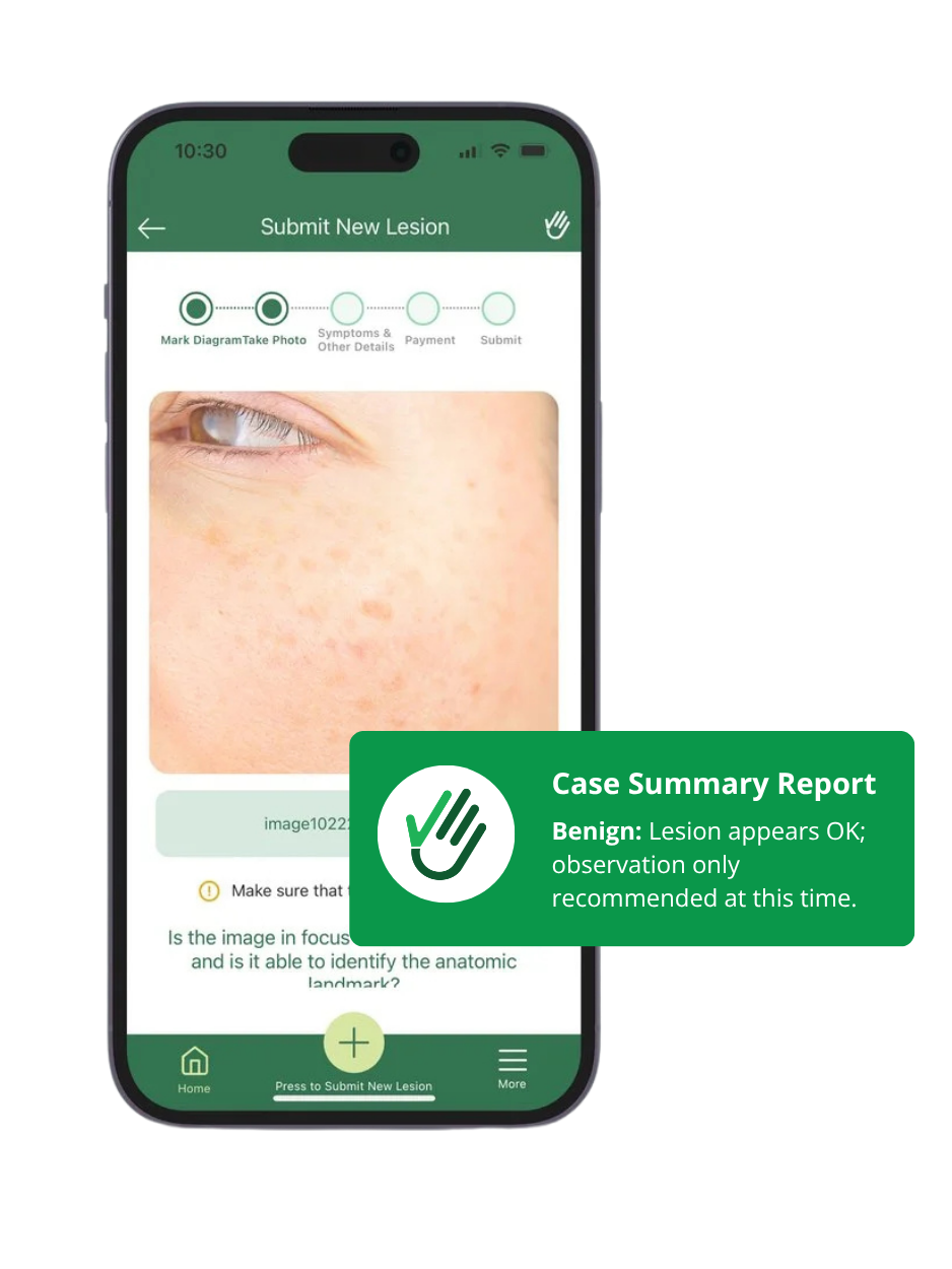 Mobile app screen showing a case report of a skin lesion with a close-up photograph of a person's cheek and skin condition. The report indicates the lesion appears benign with only observation recommended.