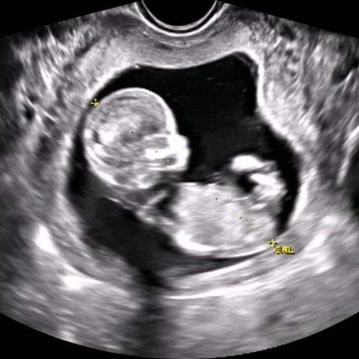 Why Do I Need an Ultrasound if I Want an Abortion?