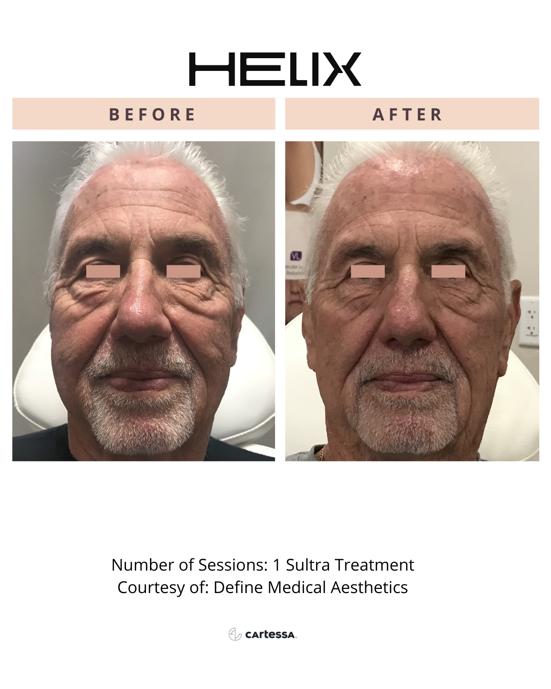 Before and After Cartessa Helix Sultra Treatment™
