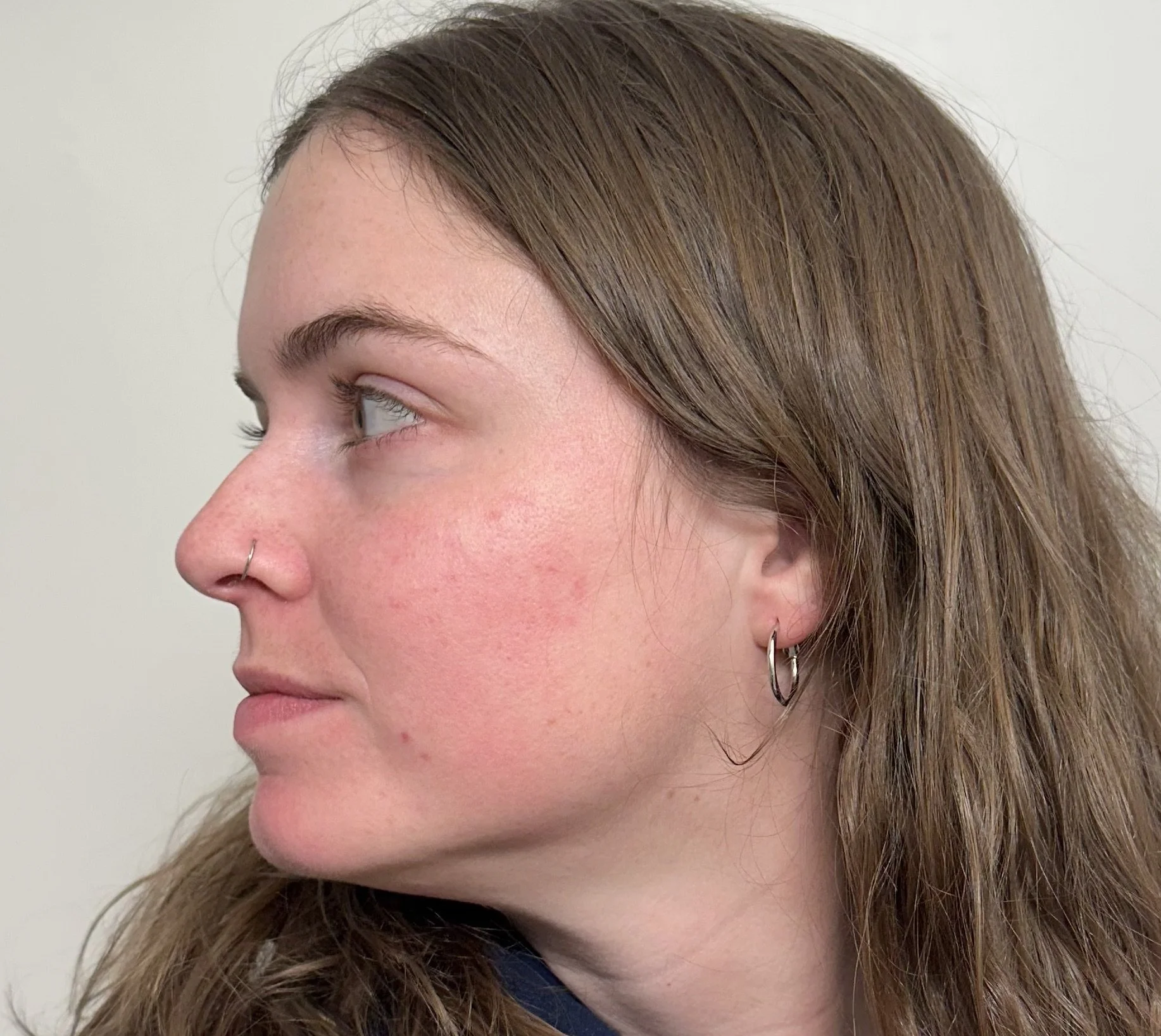 After CoolPeel™ Fusion