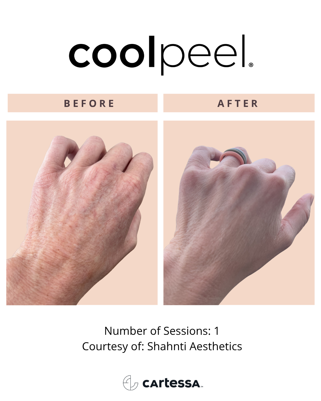 Before and After CoolPeel™