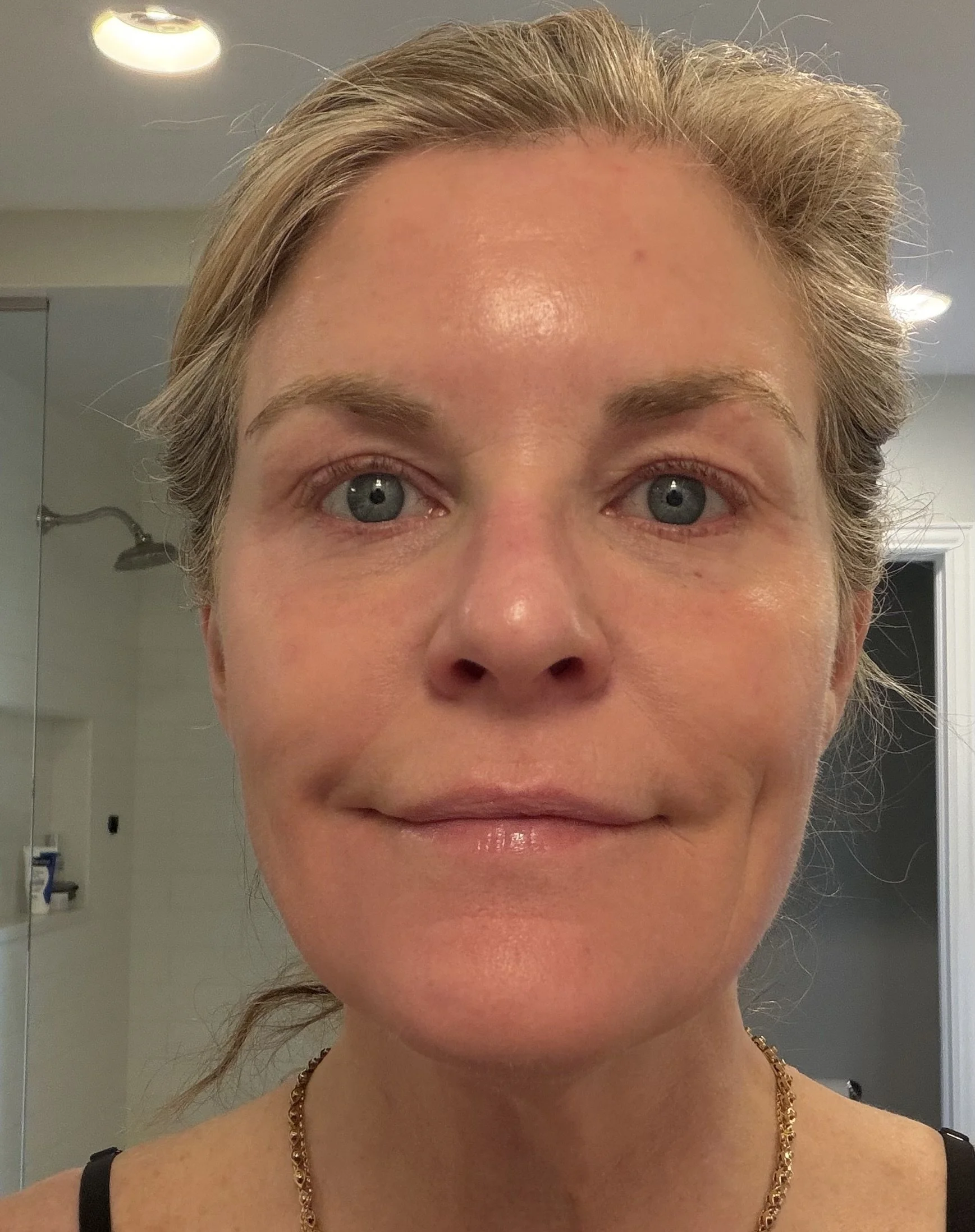 After 2 DEKA™ Fusion and 1 CoolPeel™ Fusion Treatments with upper and lower face Botox™