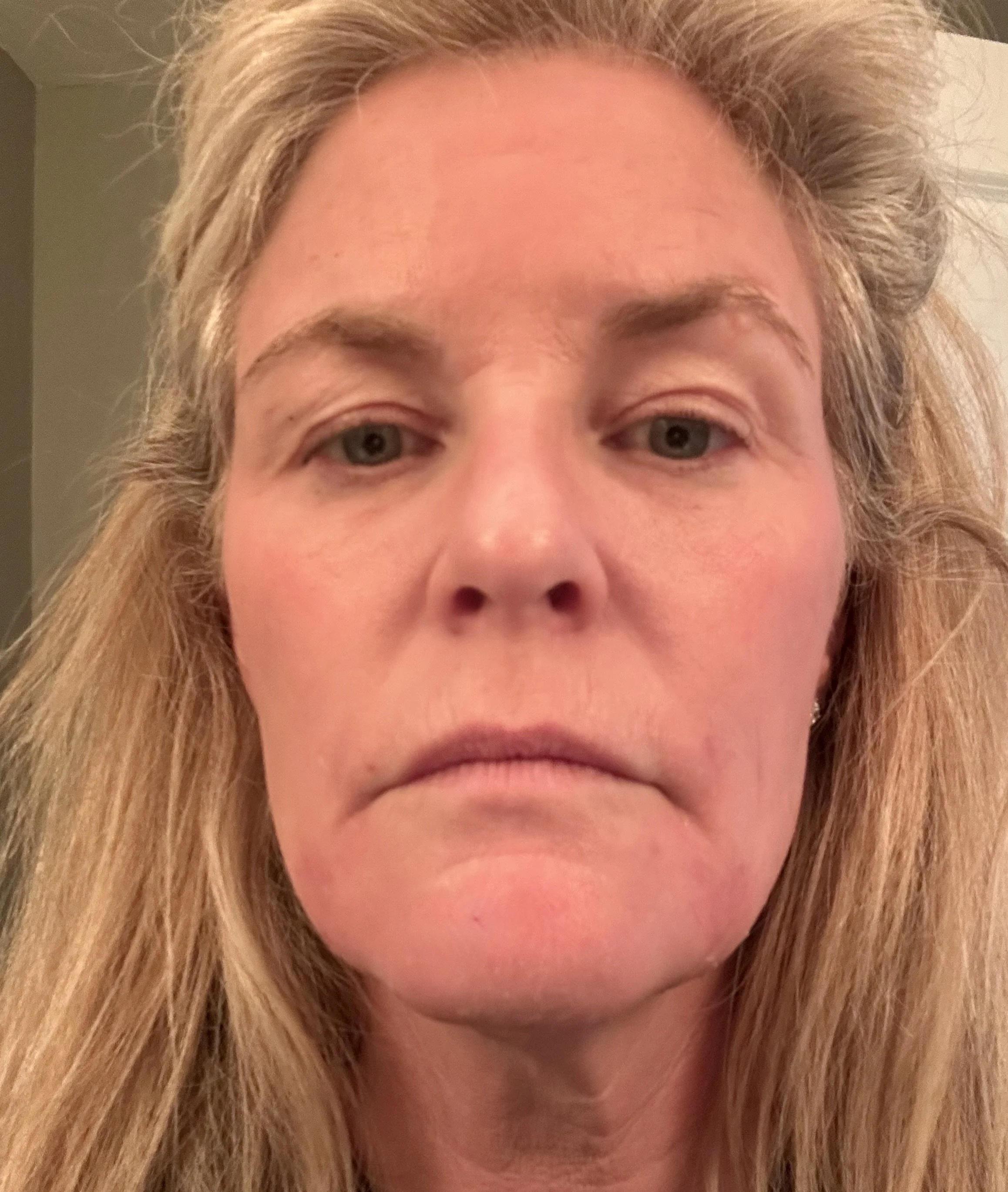 Before Helix™ and Botox™