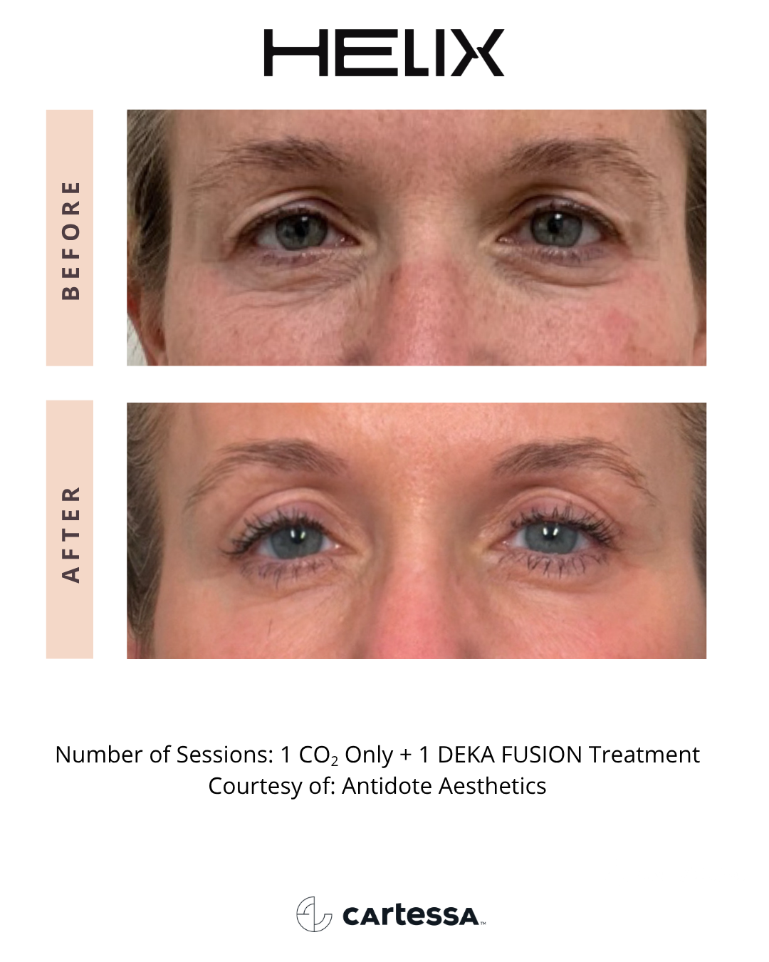 Before and After CoolPeel™ Deka Fusion Treatment