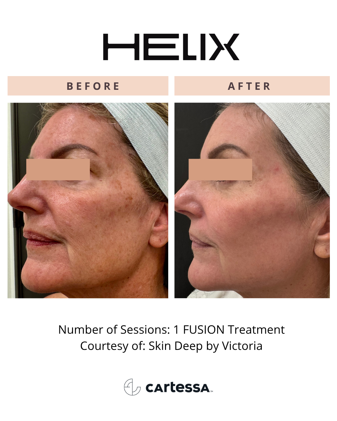 Before and After CoolPeel™ Fusion Laser Treatment