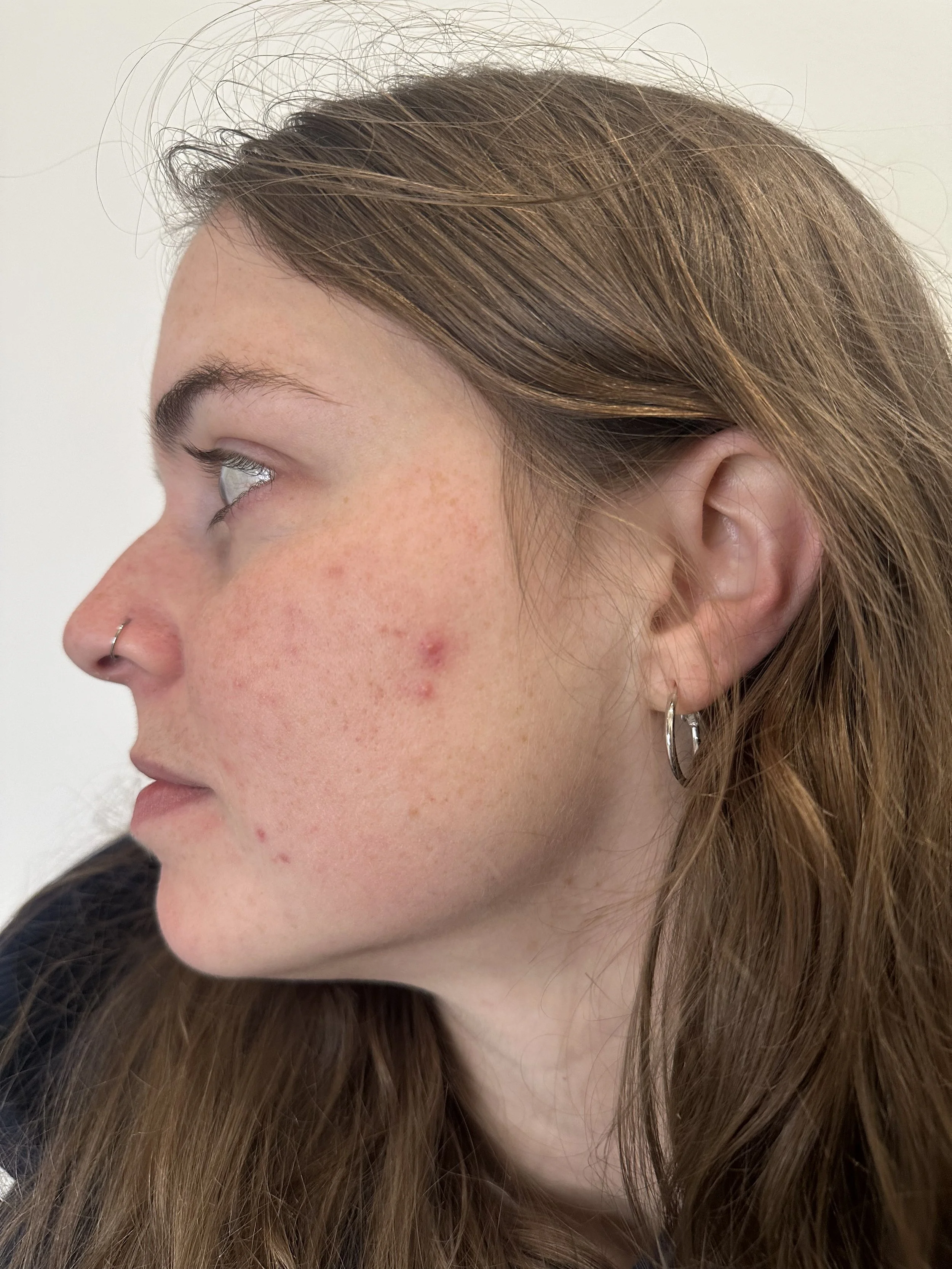 Before CoolPeel™ Fusion