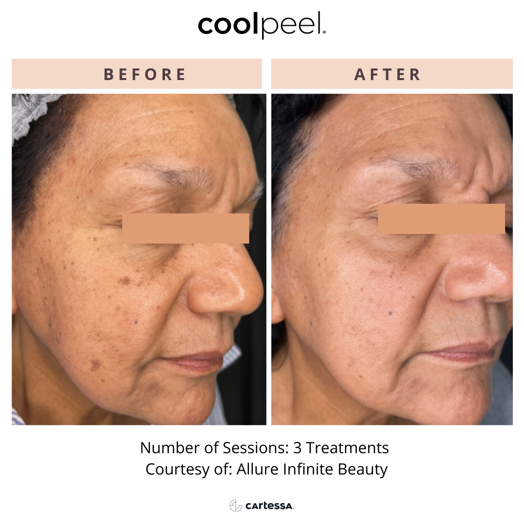 Before and After CoolPeel™