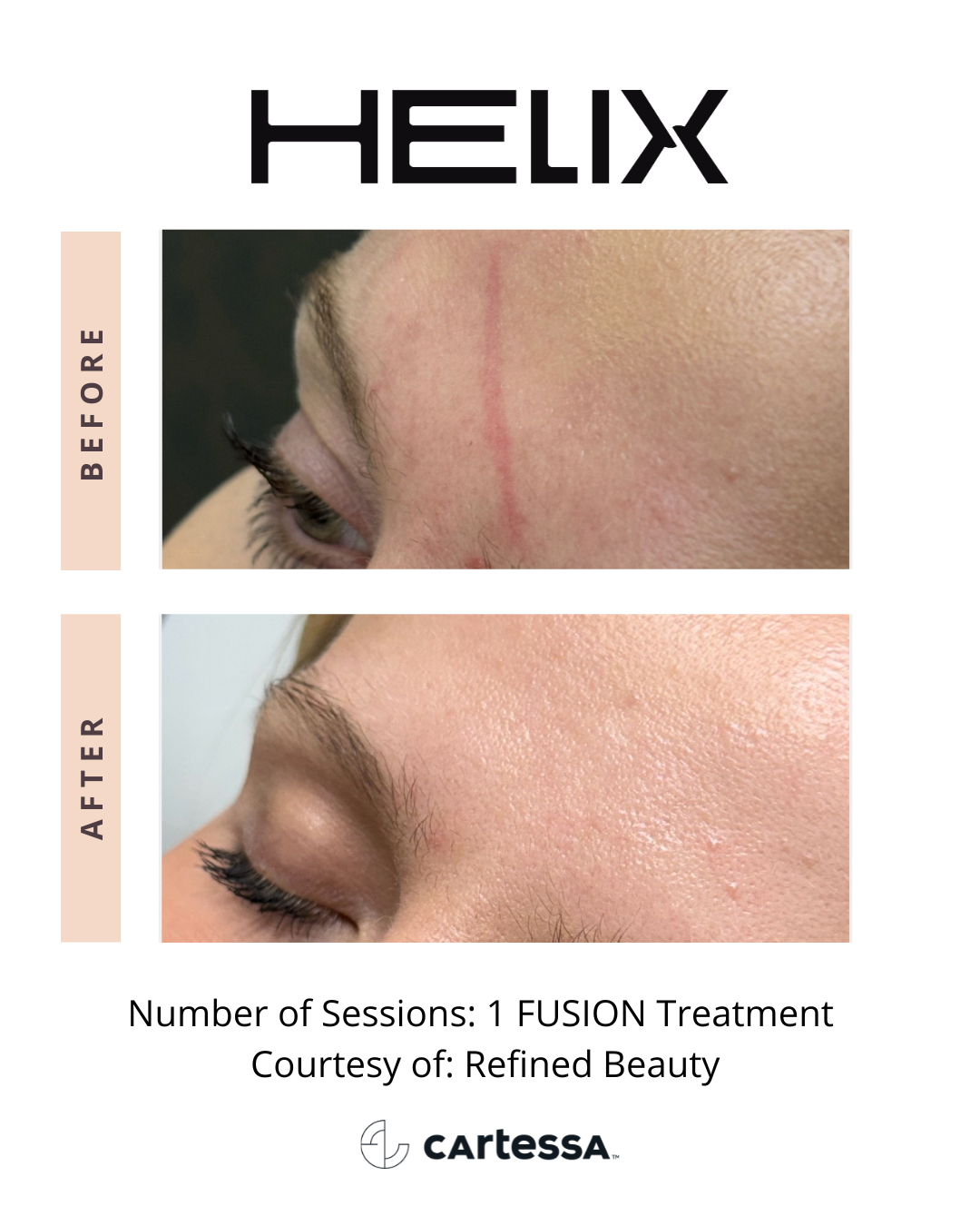 Before and After CoolPeel™ Fusion Treatment