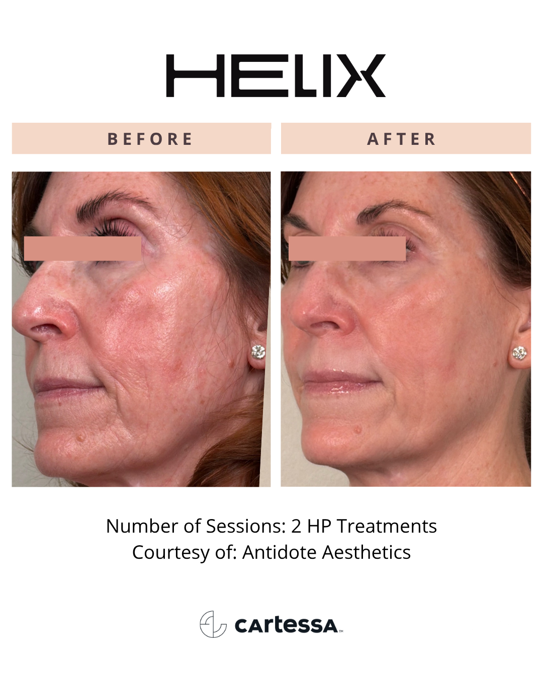 Before and After CoolPeel™