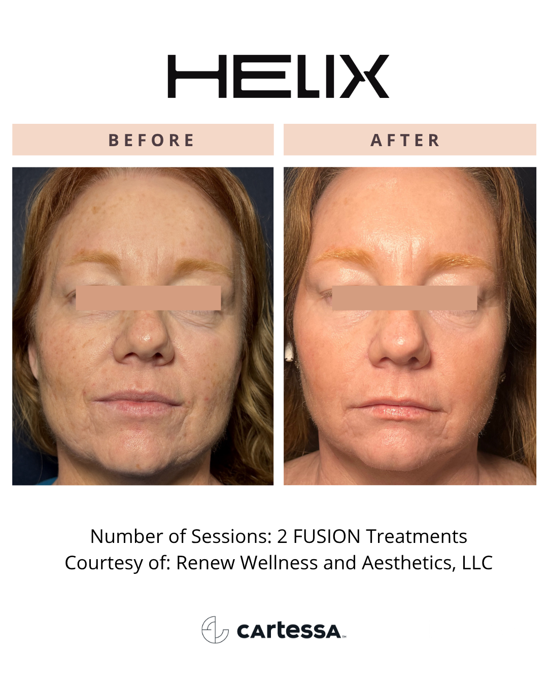 Before and After CoolPeel™ Fusion Laser Treatment