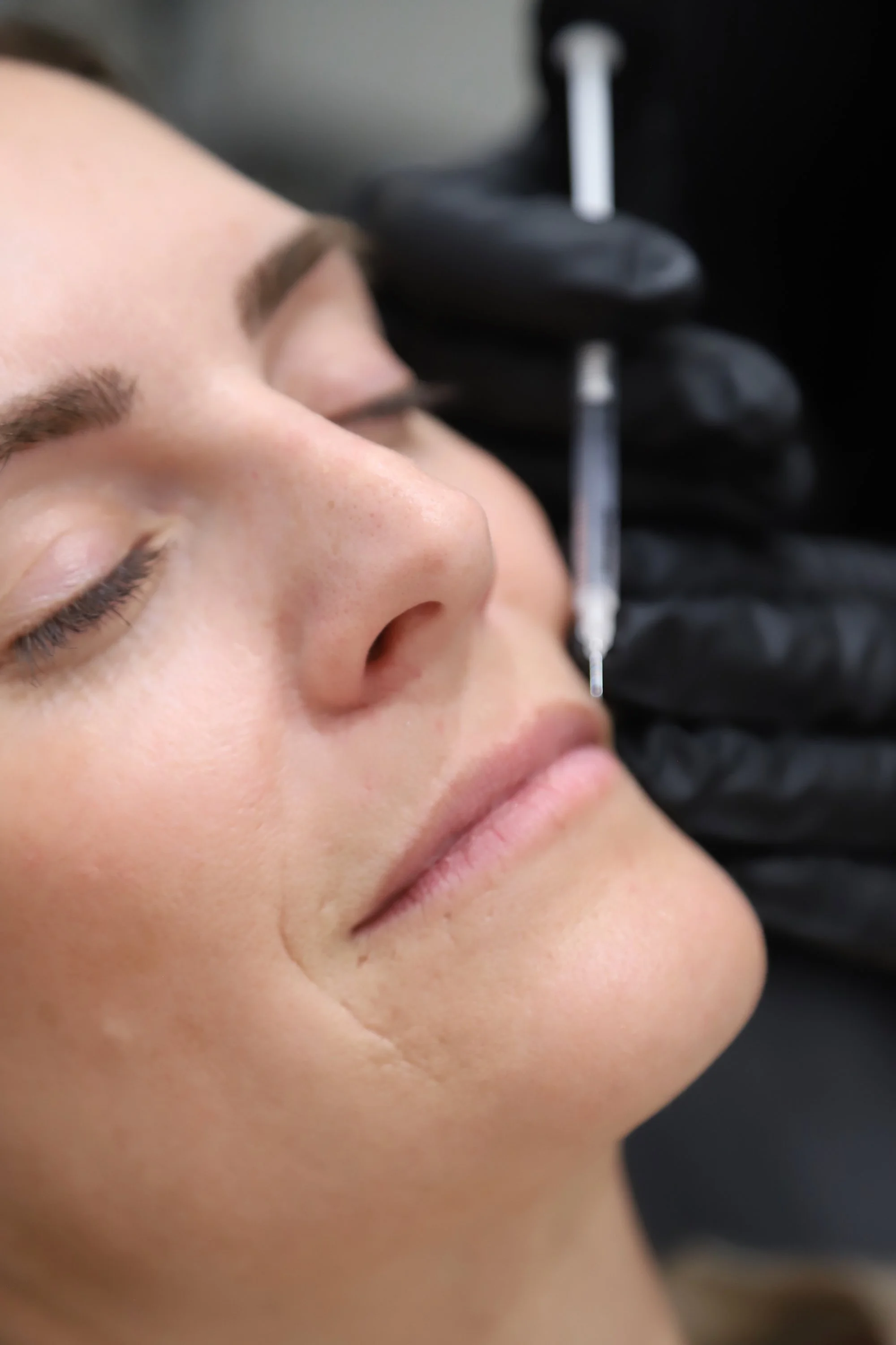 Botox injection by Dr. Alison Morrison