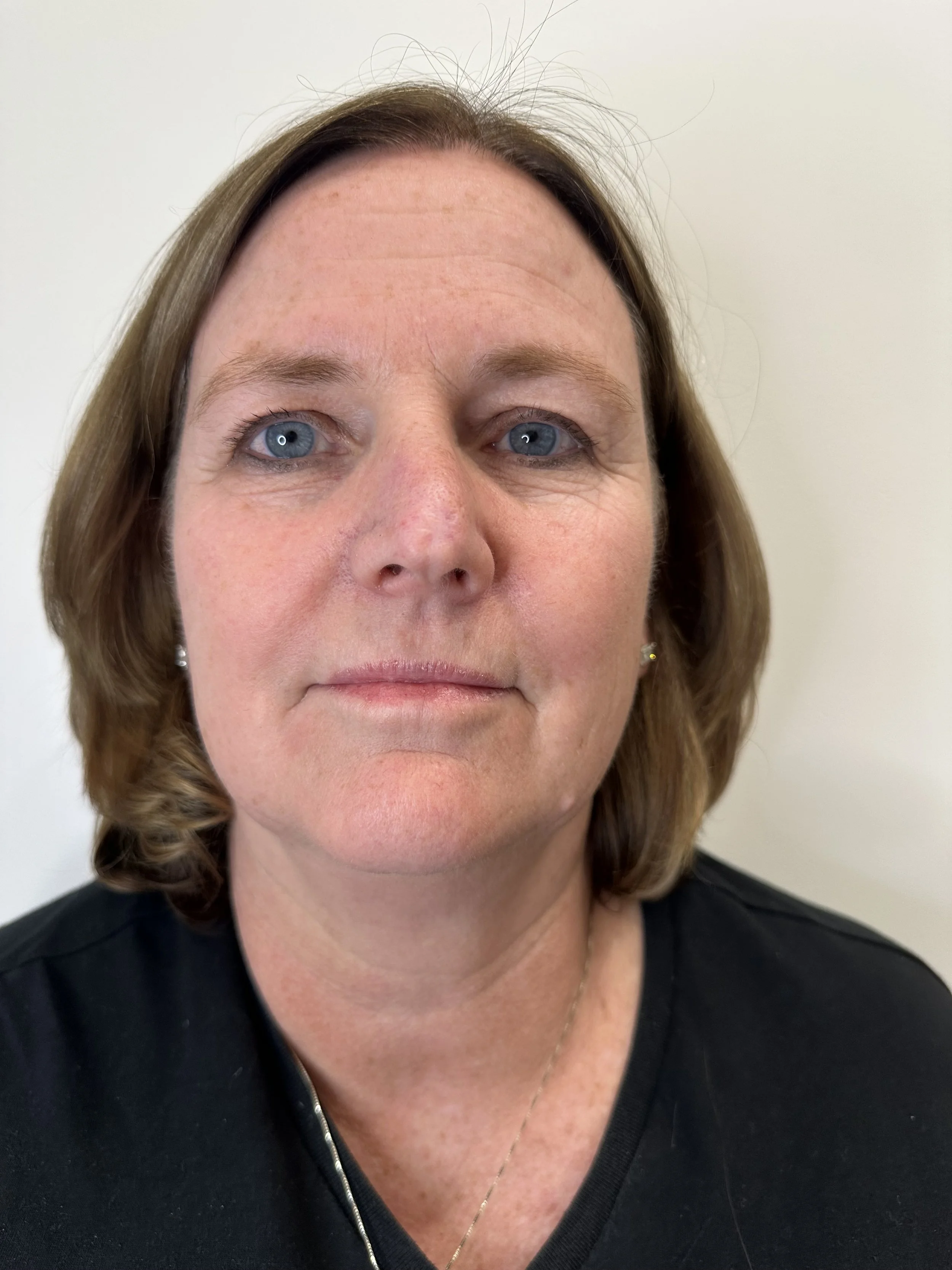 After DEKA™ Fusion