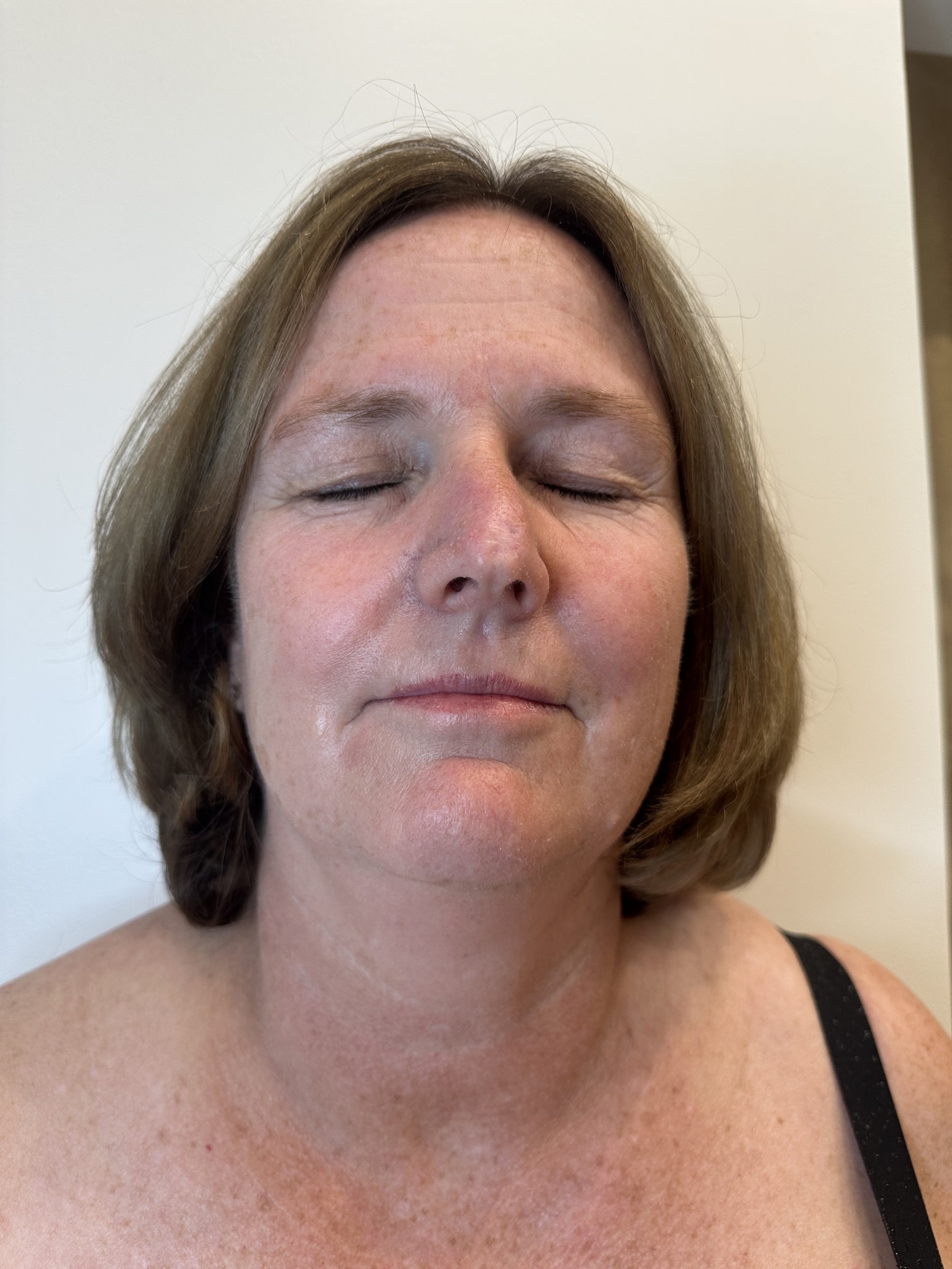 Before DEKA™ Fusion