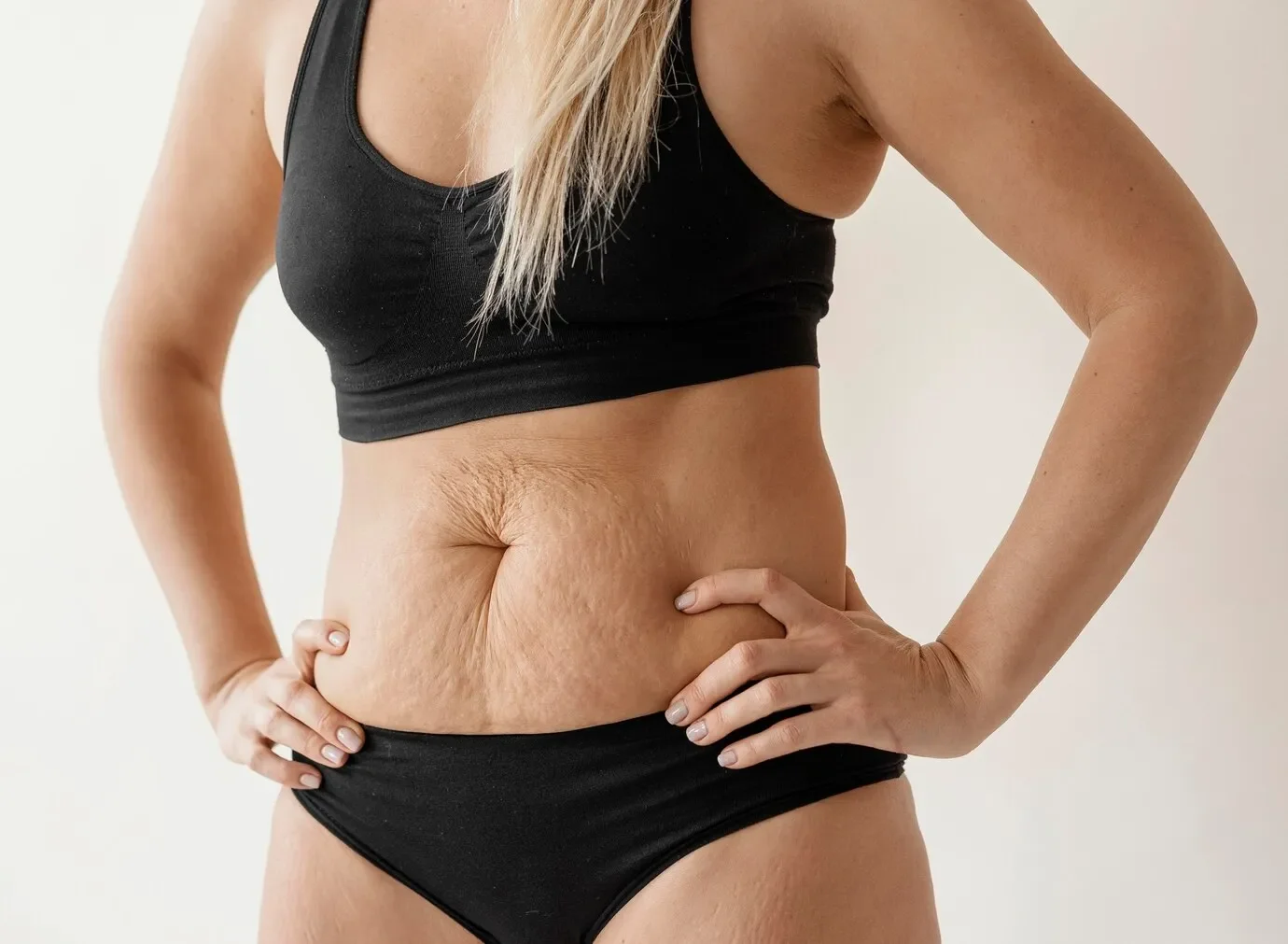 A woman in black sportswear with hands on hips shows her midsection with loose, sagging skin and stretch marks.