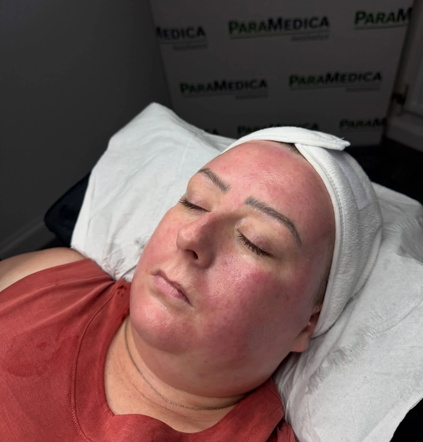 ✨ Patient Treatment Plan ✨
Following a consultation, we developed a tailored treatment plan to address my patient’s concerns regarding fine lines and wrinkles.
✅ We initially commenced with anti-wrinkle injections across three areas to reduce
