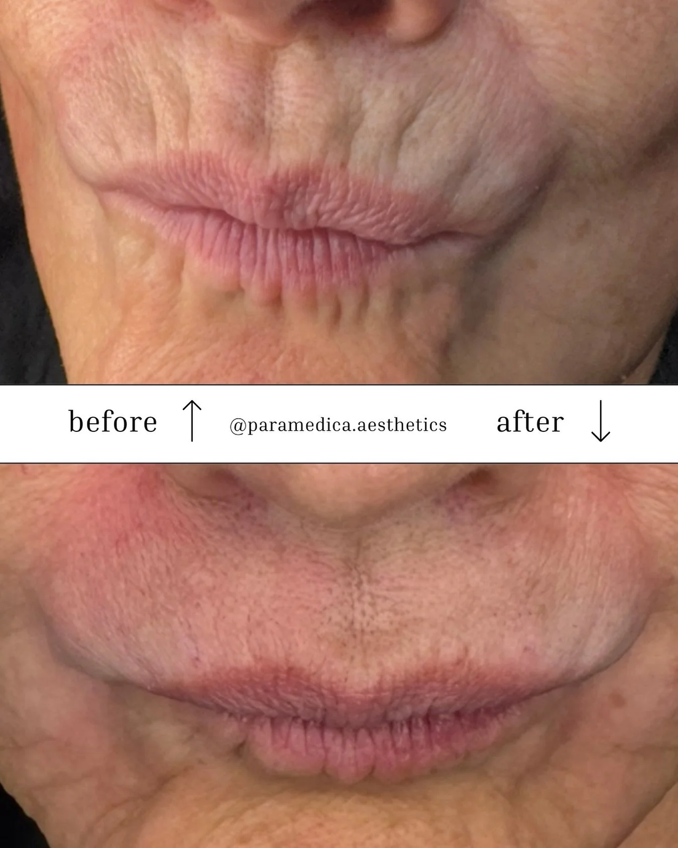 My lovely patient presented with concerns about perioral lines around her mouth. This was her first time receiving dermal filler, and she expressed a desire for a natural result, with specific concern about the risk of being overfilled. We used Teoxa