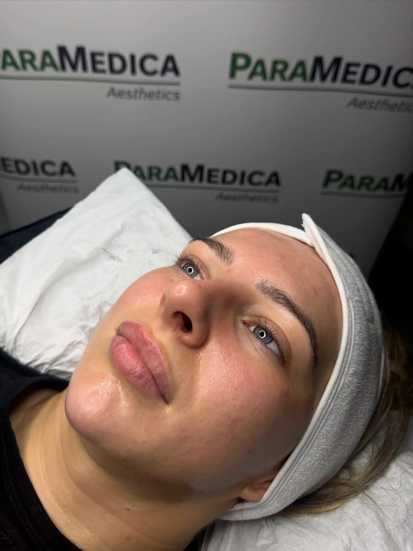 ✨ Patient Treatment Plan! ✨
Following a combination Dermaplane and Microdermabrasion facial, this patient has a noticeable post-treatment glow. 
She has completed a comprehensive treatment plan incorporating:
• Biostimulators to stimulate coll