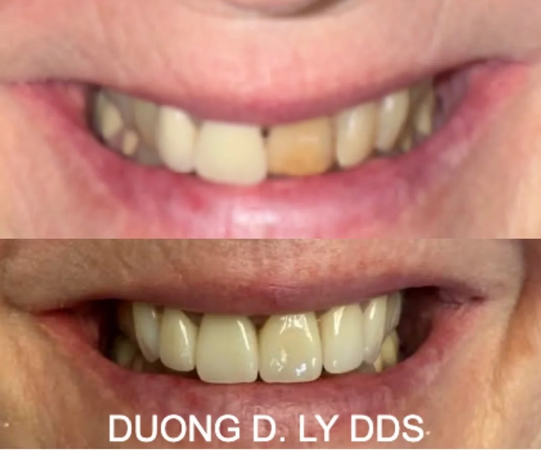 Smile Transformations You Can Trust in Southwest Washington! 

At Twin City Smiles, Dr. Duong D. Ly, DDS is creating confident, healthy smiles for patients across Centralia, Chehalis, Olympia, Lacey, and surrounding areas. 

Just look at this incredi