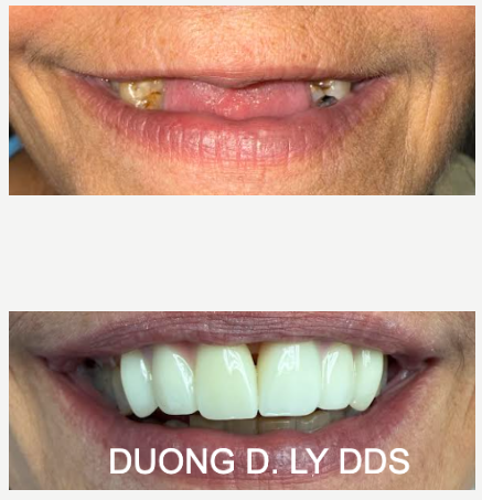 Dental implant bridge before and after in Centralia WA near Chehalis and Lewis County – smile restoration at Twin City Smiles