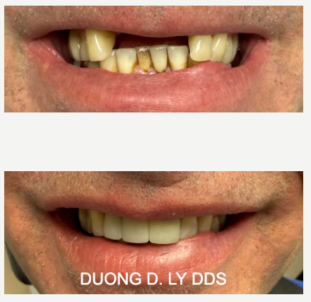 After custom implant bridge in Centralia WA – restored smile by Dr. Duong Ly at Twin City Smiles Family Dentistry