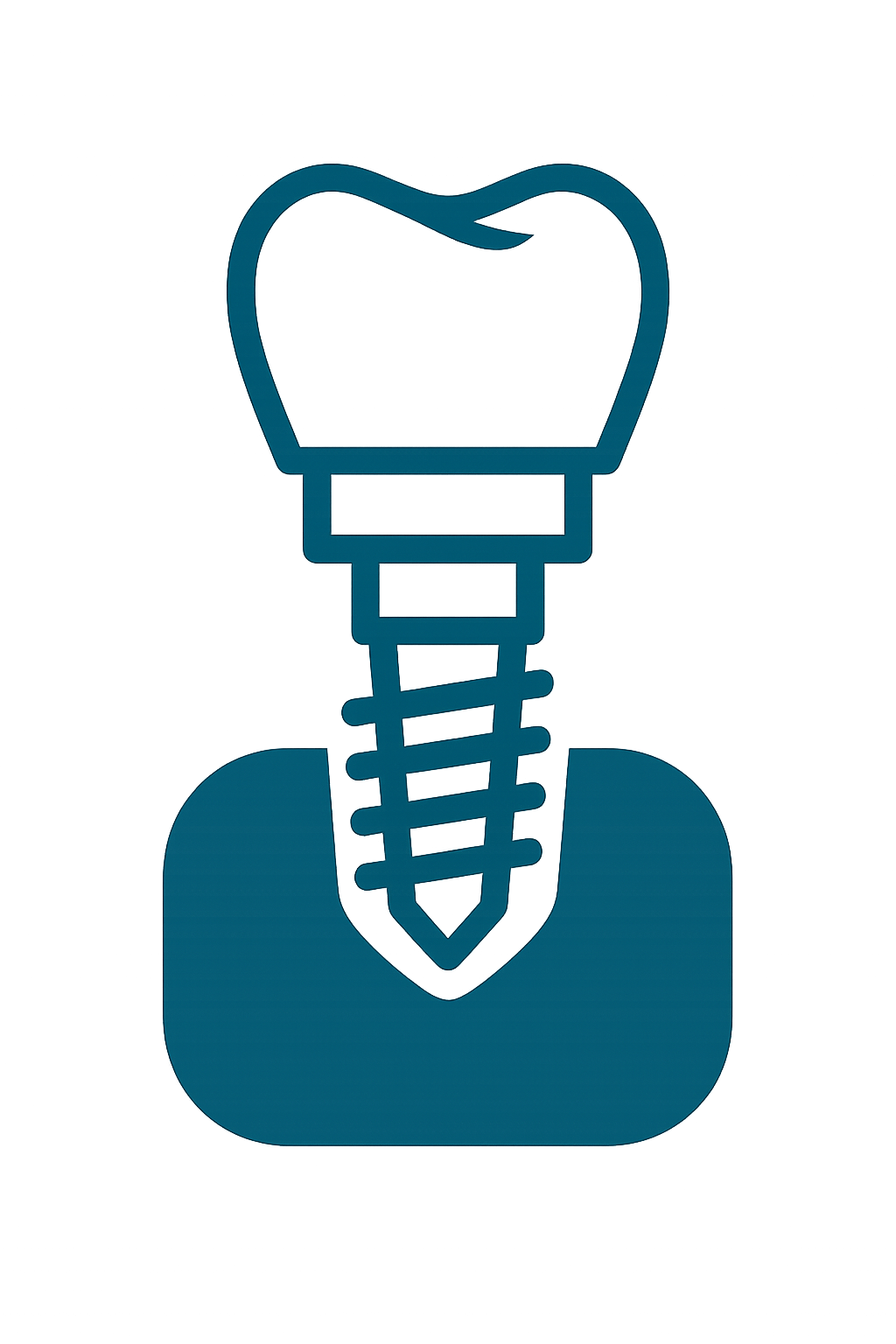 Dental Implants for missing teeth