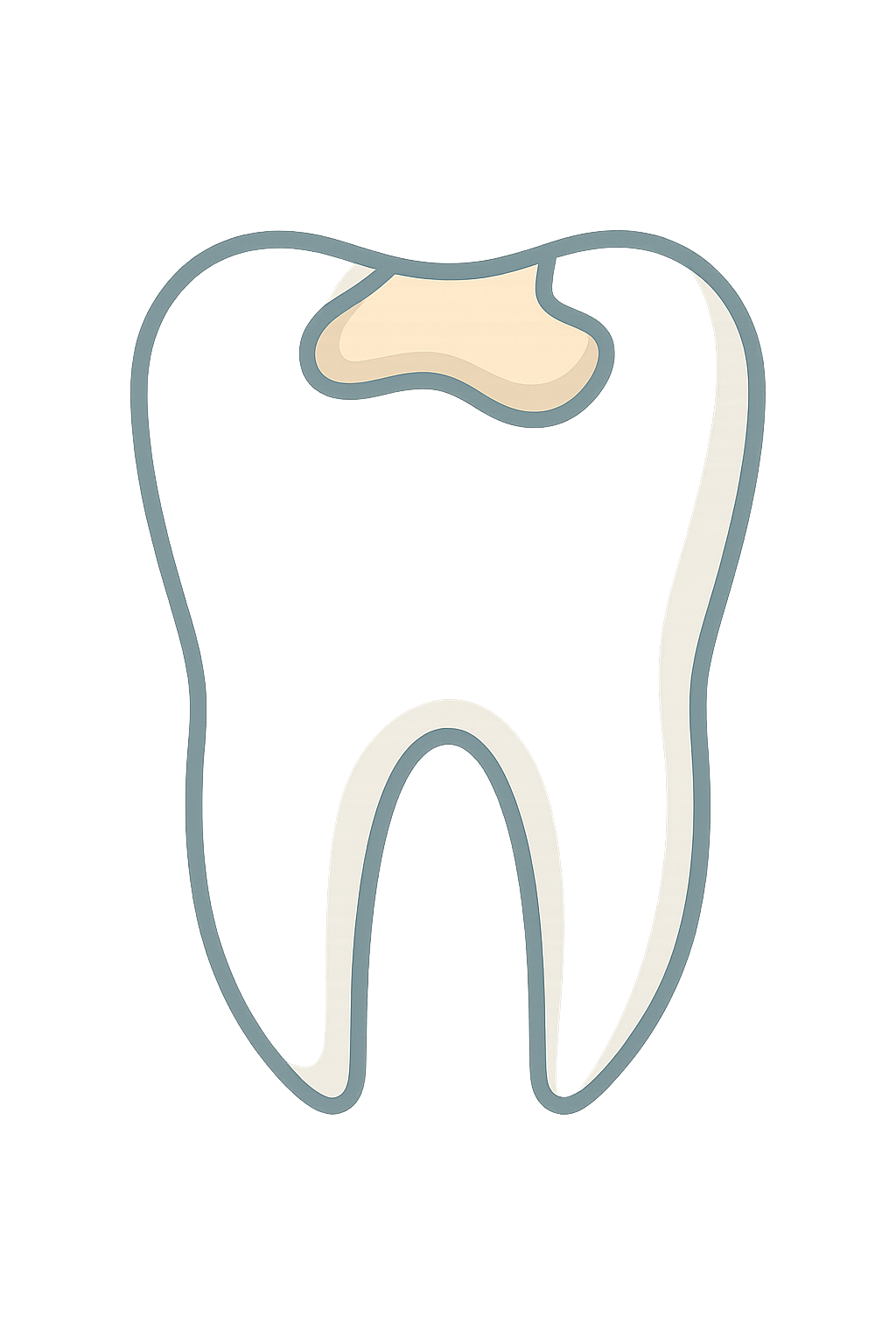 Tooth Colored Mercury Free Fillings