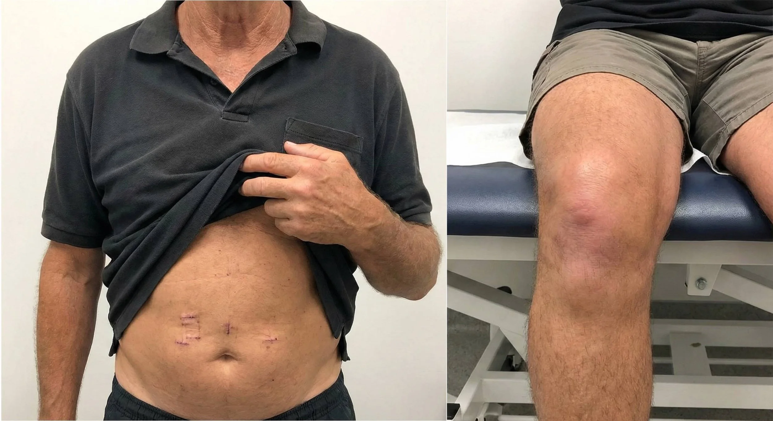 Case Study: Rapid Improvement in Post-Fall Knee Pain Through Fascial Counterstrain