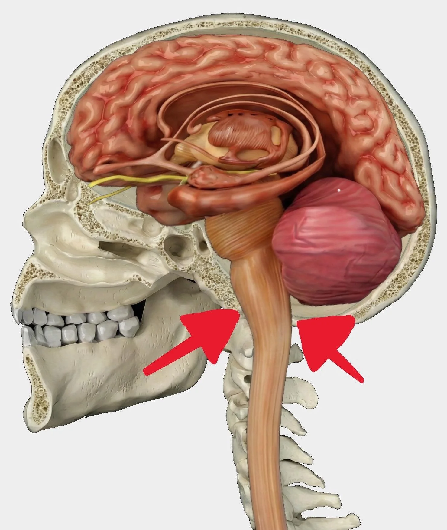 Spinal cord tension from fascial restriction