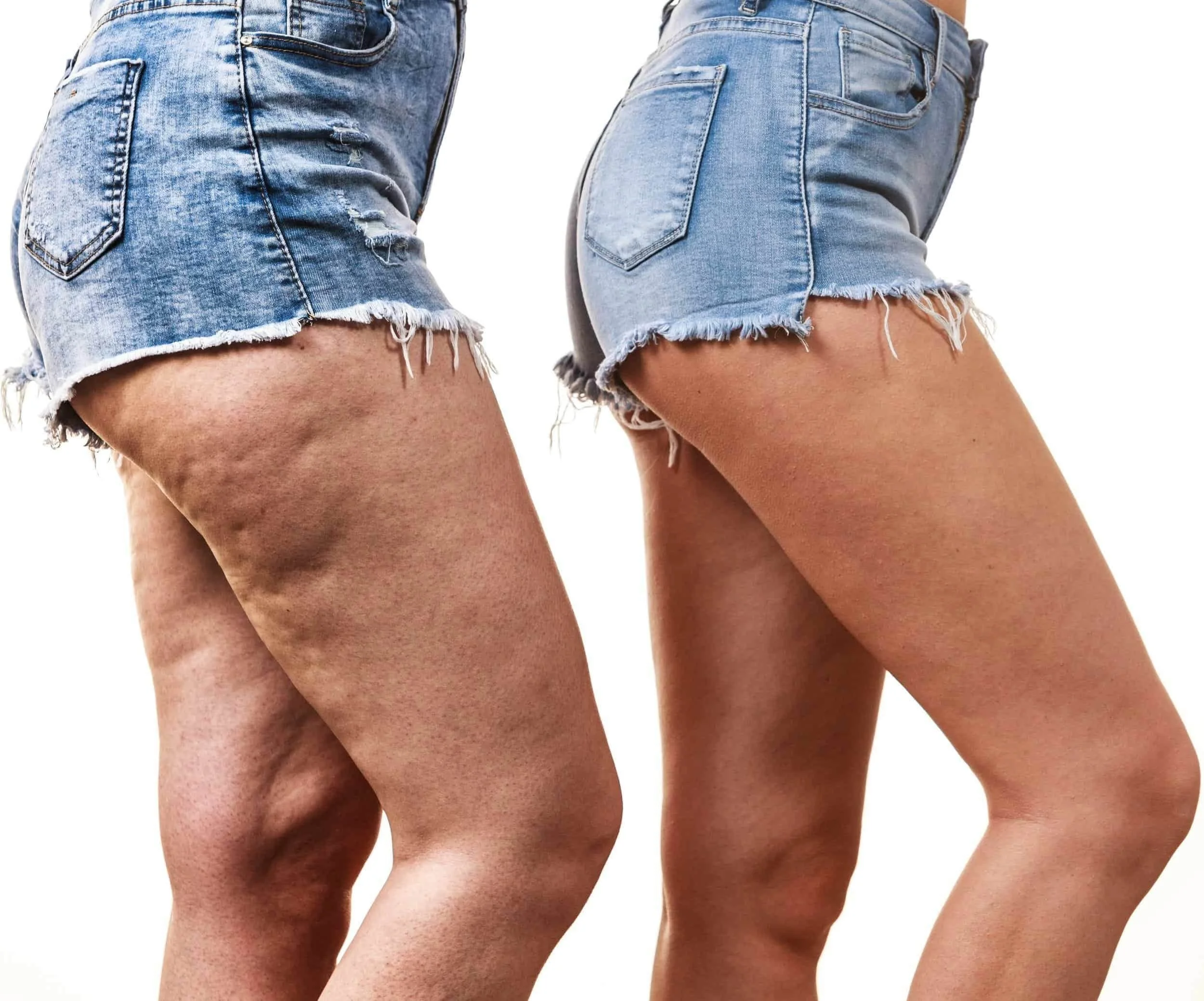 Side-by-side comparison of two women wearing distressed denim shorts, one with cellulite and one with smooth skin.