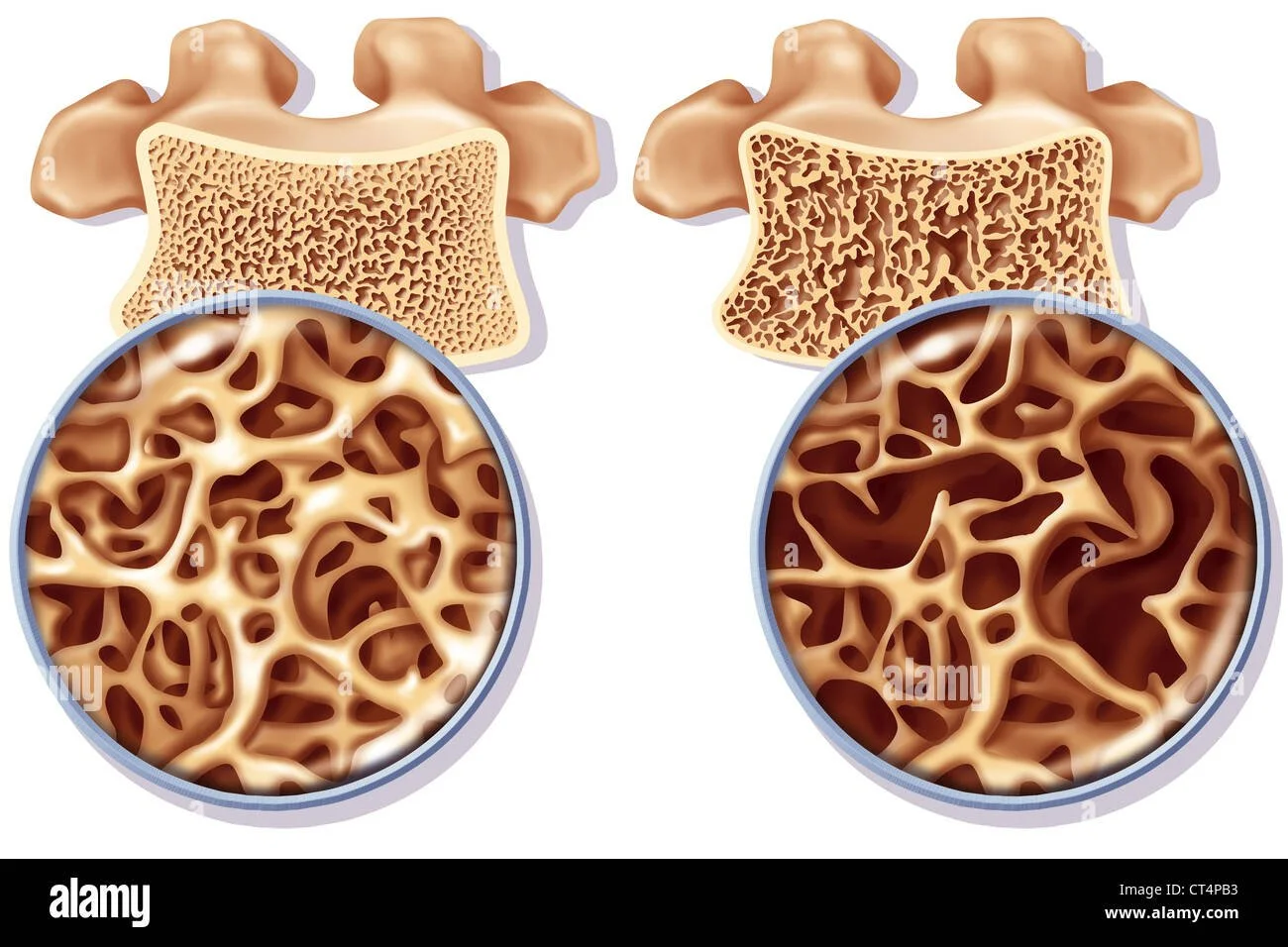 Comparison of healthy and osteoporotic vertebral bone structure, with magnified views showing denser bone tissue on the left and more porous, brittle bone on the right.