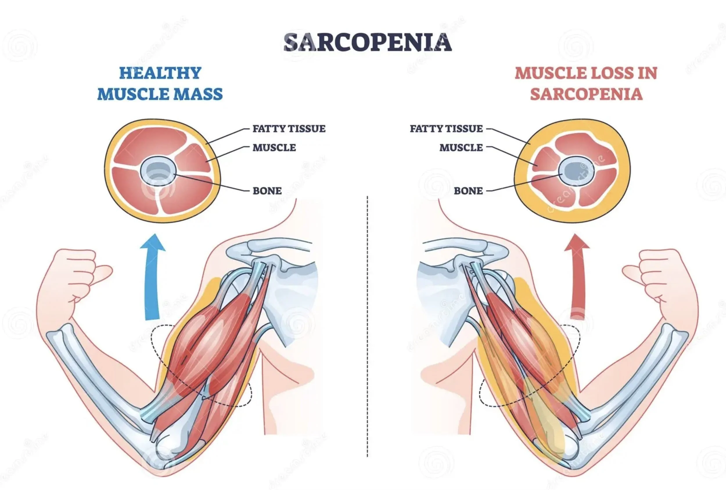 Diagram comparing healthy muscle mass and muscle loss in sarcopenia. The left side shows a cross-section of a muscle with labeled fat tissue, muscle, and bone, indicating healthy muscle. An illustration of a flexed arm shows healthy muscle mass. The 