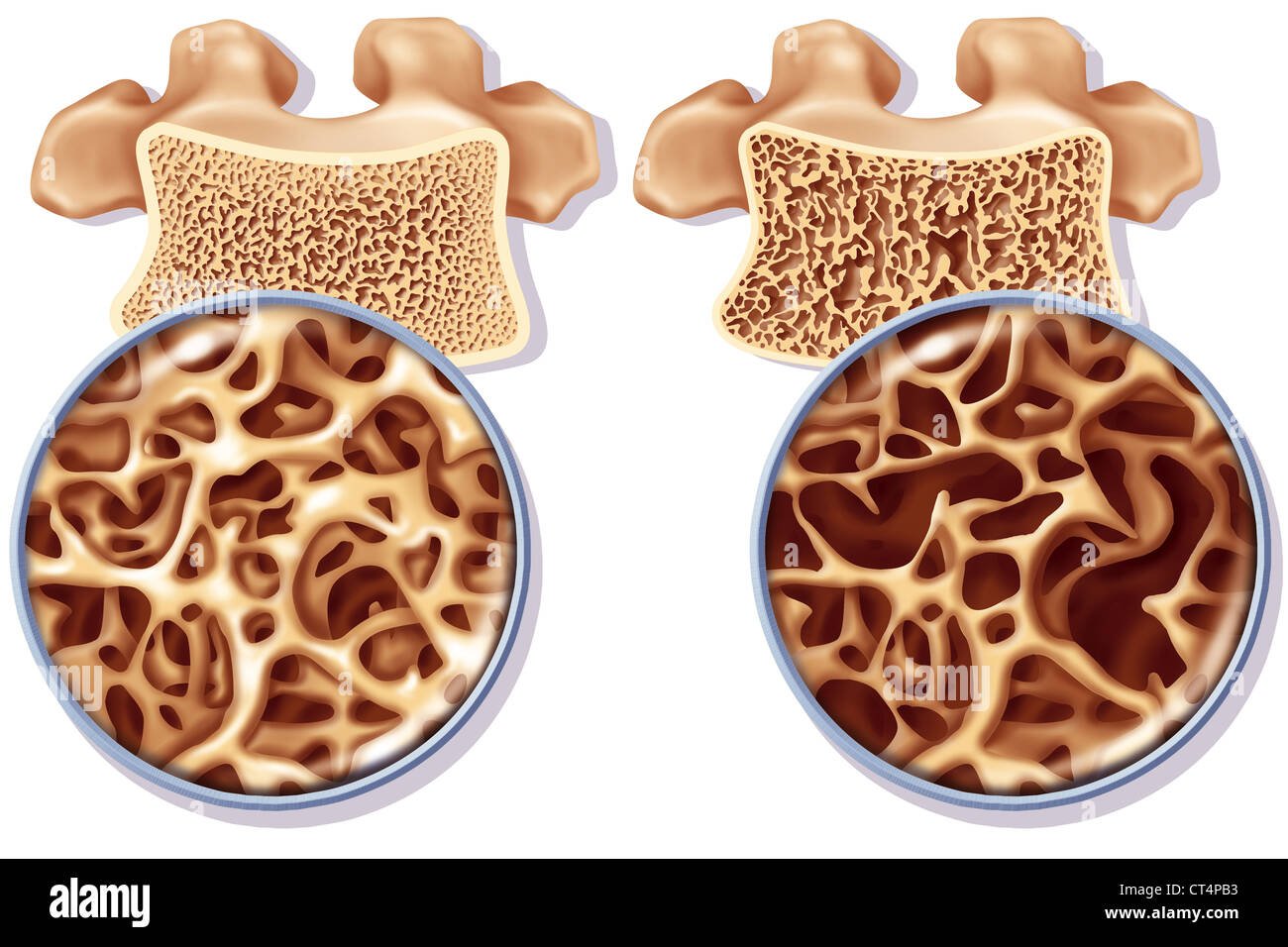 Comparison of healthy and osteoporotic vertebral bone structure, showing a denser, healthier inner bone on the left and more porous, weakened bone on the right.