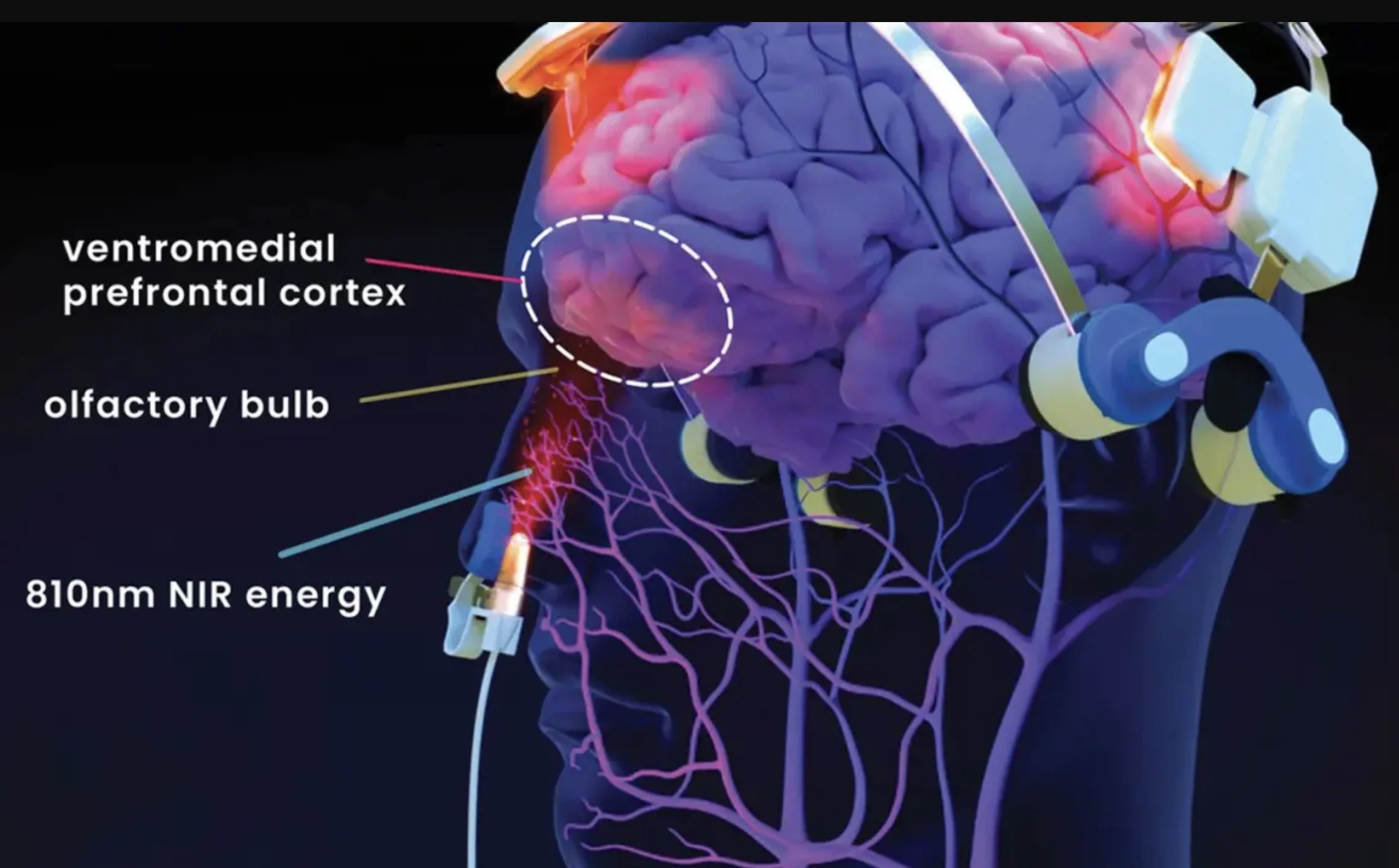 Diagram of a brain with labels showing ventromedial prefrontal cortex, olfactory bulb, and an 810 nm near-infrared energy device targeting the olfactory bulb.