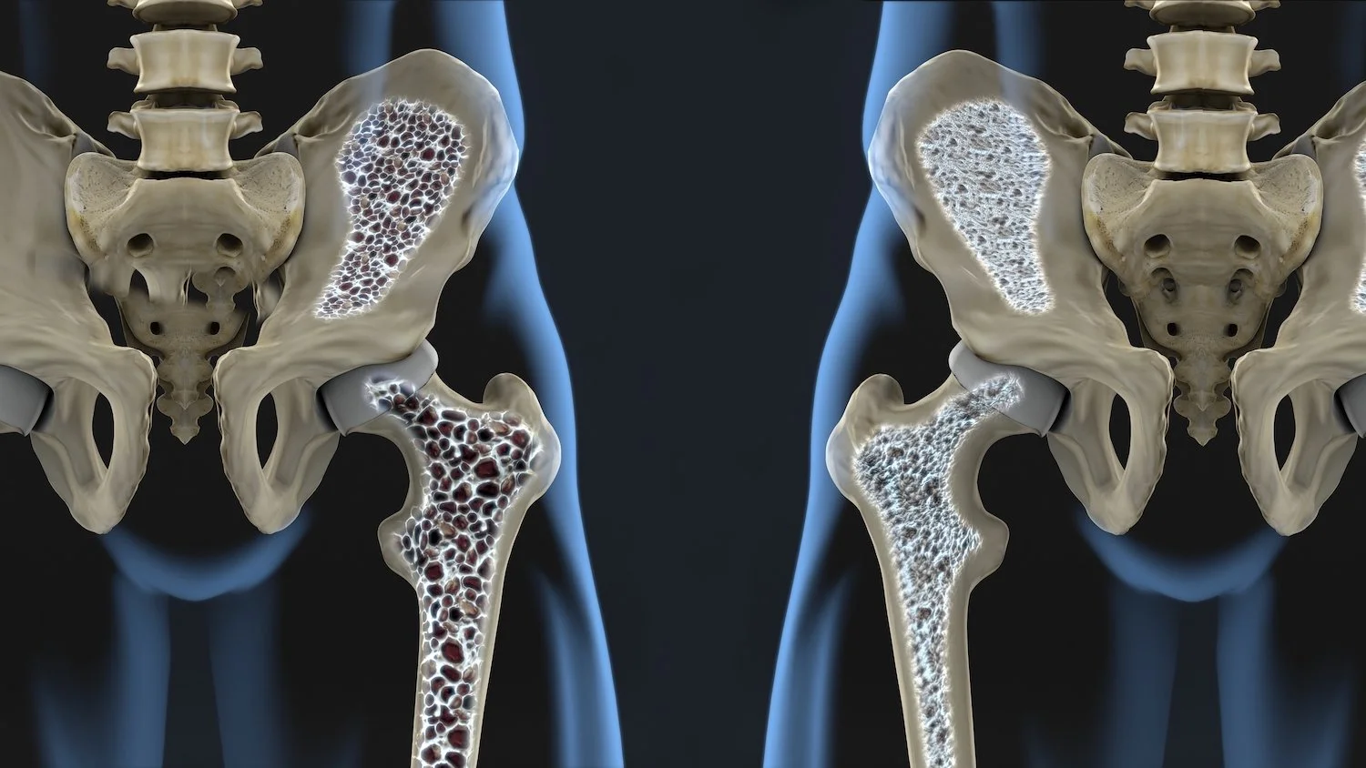 Medical illustration showing healthy and osteoporotic pelvic bones and hips, highlighting bone density differences.