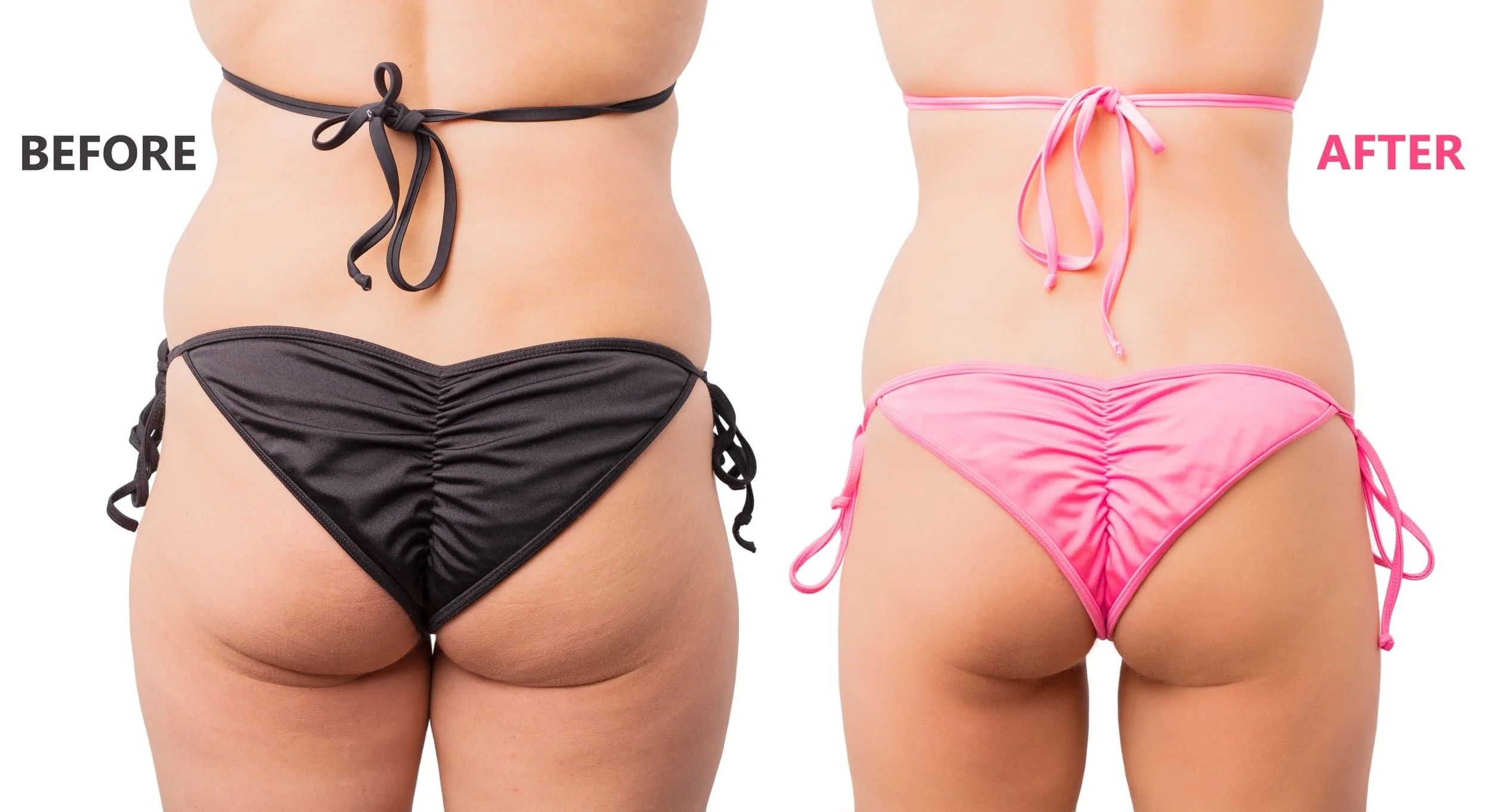 Comparison of a woman's lower back and buttocks before and after weight loss, showing a black bikini on the left labeled 'BEFORE' and a pink bikini on the right labeled 'AFTER'.