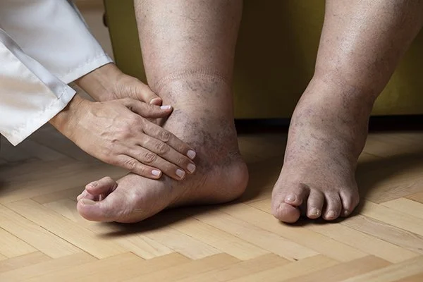 Close-up of a person's swollen and bruised ankle and foot, being examined by a healthcare professional.