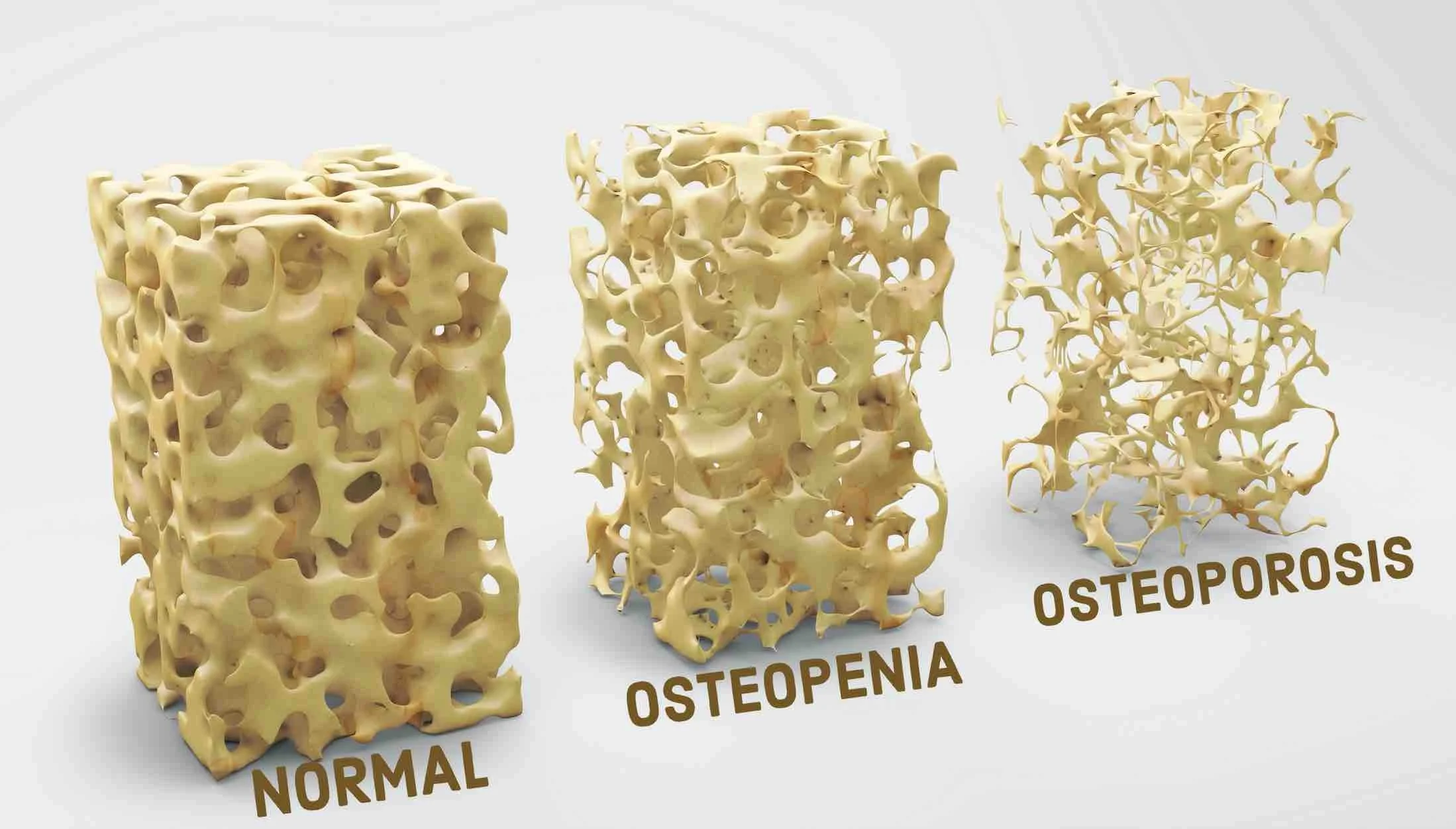 Comparison of 3D bone structures labeled 'Normal', 'Osteopenia', and 'Osteoporosis', showing decreasing density and increasingly porous bone as conditions progress.