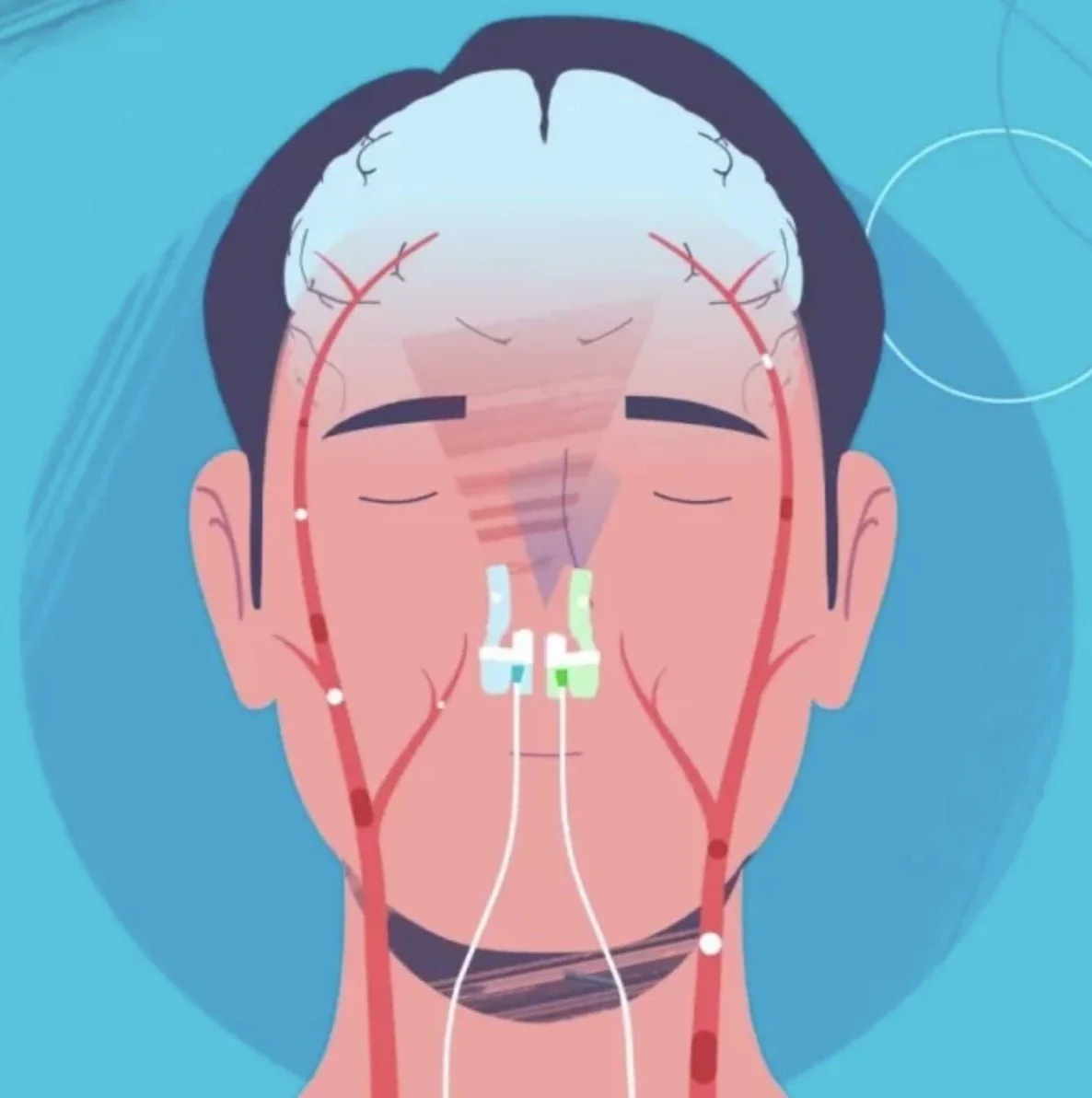 Illustration of a person's face with medical lines indicating a brain procedure, connected to tubes and monitors, in a clinical setting.