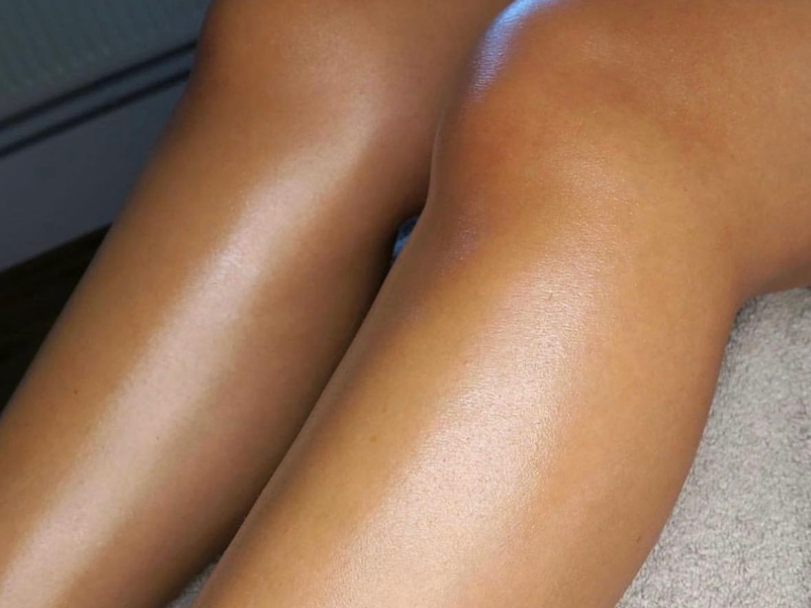 Laser hair removal results on legs – smooth, stubble-free skin