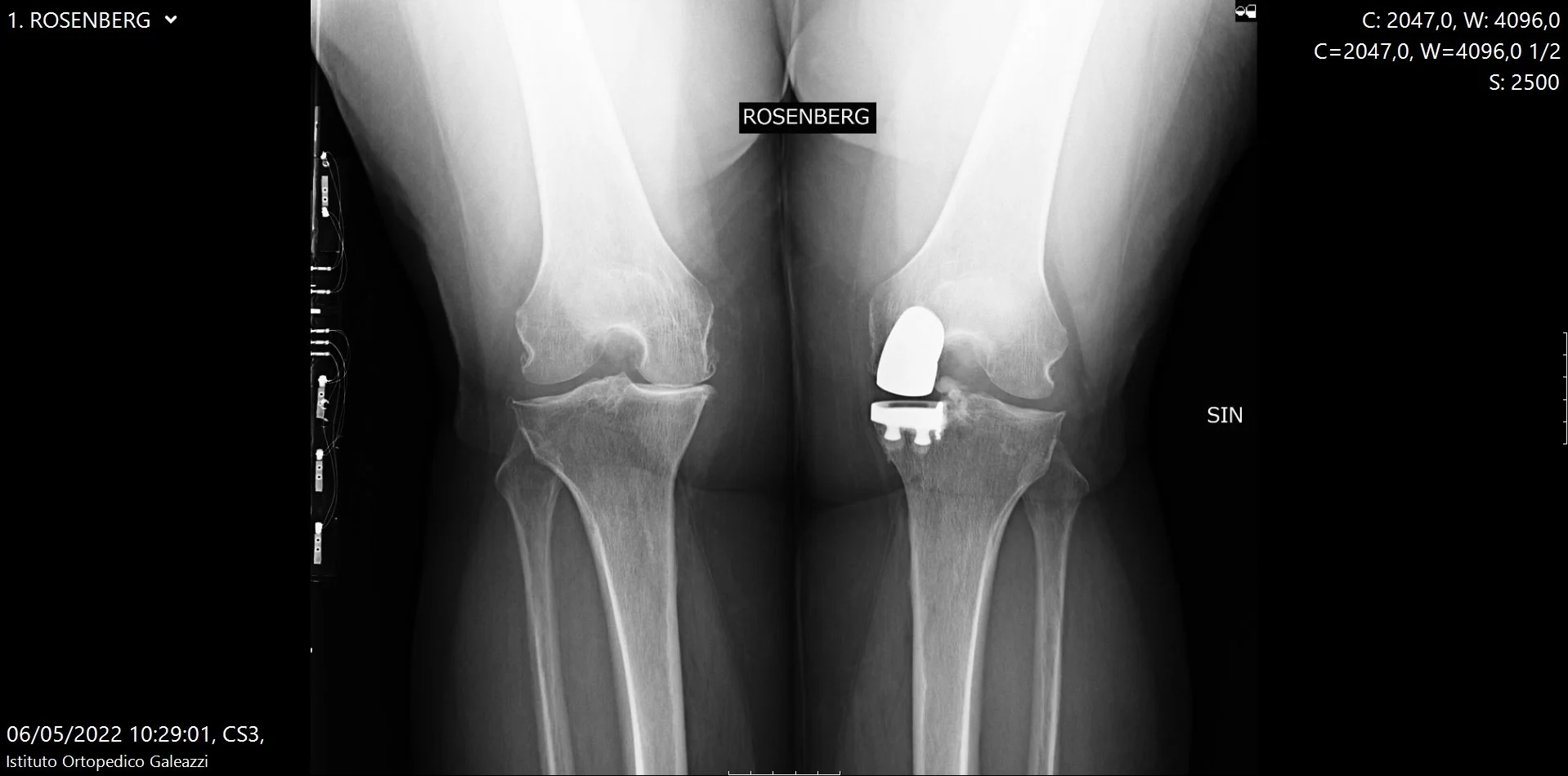 Radiografia ginocchia in proiezione di Rosenberg sotto carico per valutazione dell’artrosi