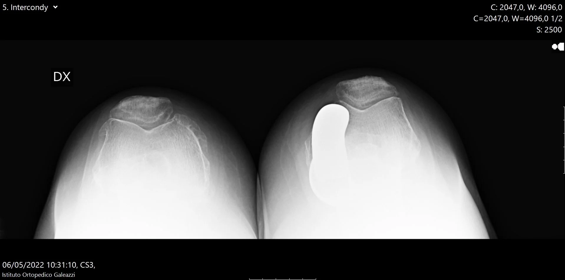 Radiografia assiale di rotula per valutazione dell’articolazione femoro-rotulea