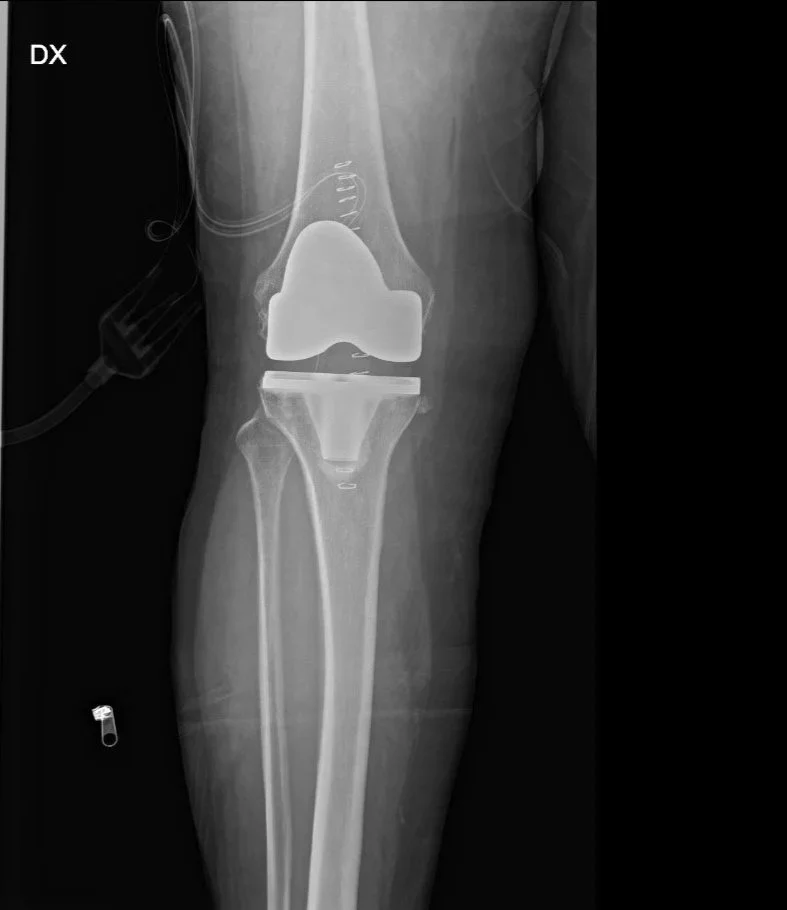 Radiografia di un ginocchio con protesi totale, utilizzata dal Dott. Fabrizio Bertelle per spiegare come mantenere nel tempo la funzionalità di un ginocchio protesico.
