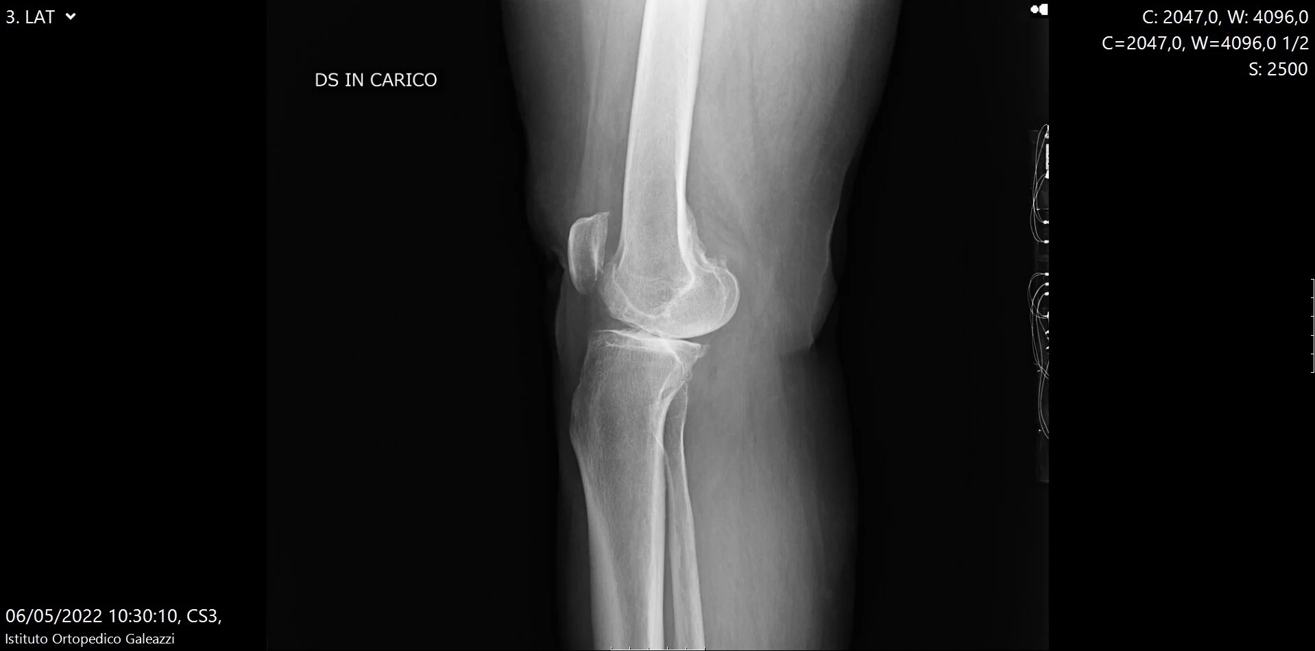 Radiografia laterale del ginocchio sotto carico per valutazione dell’artrosi