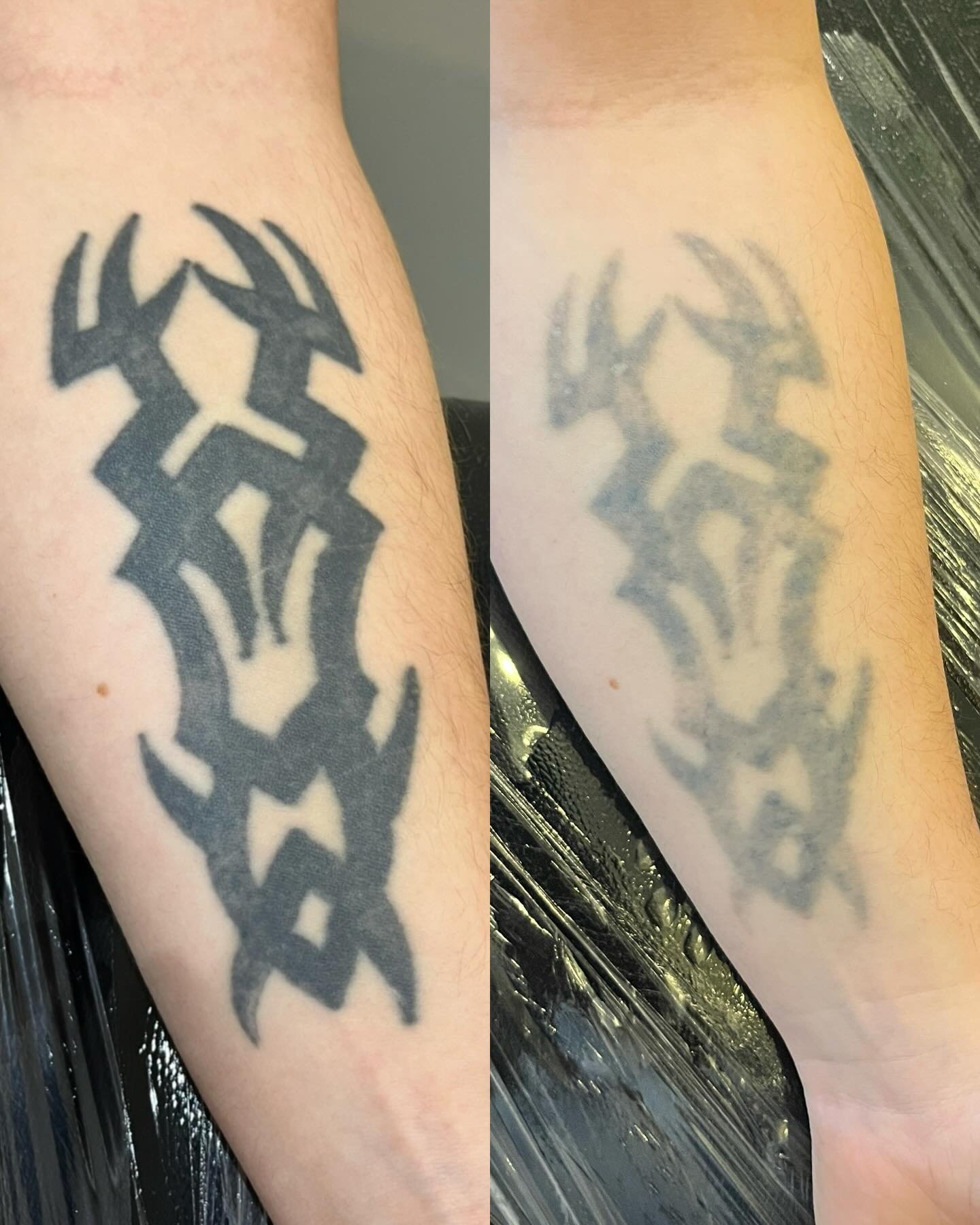 Solid black tribal? No bother! Client is just about to start a black &amp; grey sleeve on his other arm. When this ones ready, he&rsquo;ll be doing the same. 
.
.
.
#lasertattooremoval #tattooremovalnewcastle #tattooremovalwhitleybay #tattooremovalno
