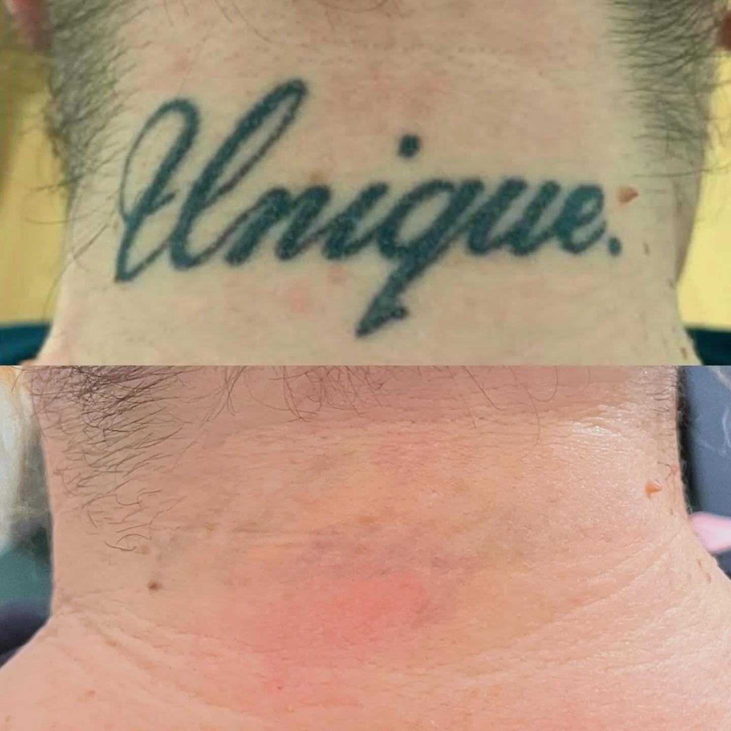 2026 lets gooooo!
.
.
#lasertattooremoval #tattooremovalnewcastle #tattooremovalwhitleybay #tattooremovalnorthshields #tattooremovaltynemouth #lasertattooremovalwhitleybay #whitleybay #lasertattooremovalnewcastle #newcastleupontyne #whitleybaytattoo