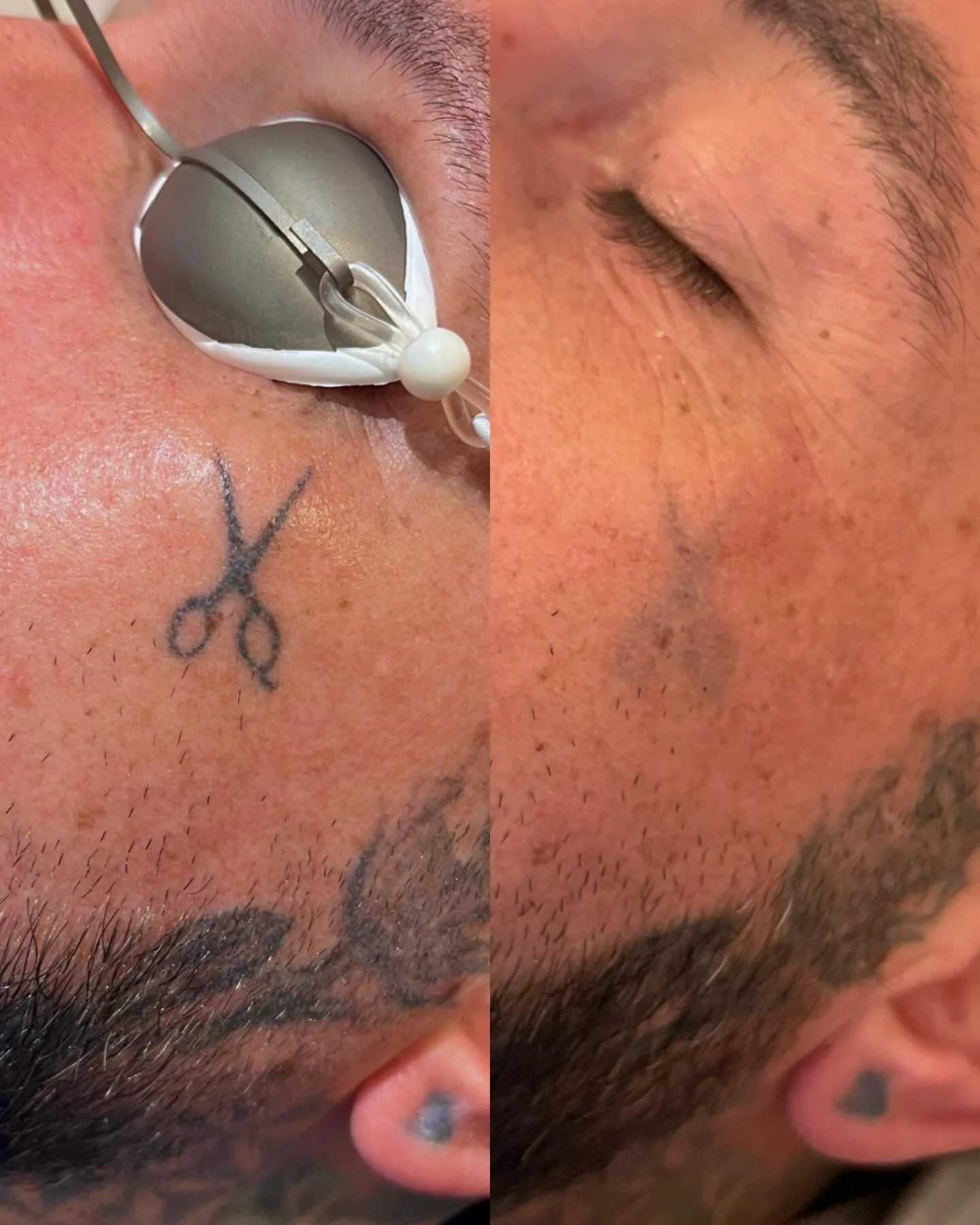 Saying bye to this unwanted face tat. So close to being gone for good. 
.
.
#lasertattooremoval #tattooremovalnewcastle #tattooremovalwhitleybay #tattooremovalnorthshields #tattooremovaltynemouth #lasertattooremovalwhitleybay #whitleybay #lasertattoo